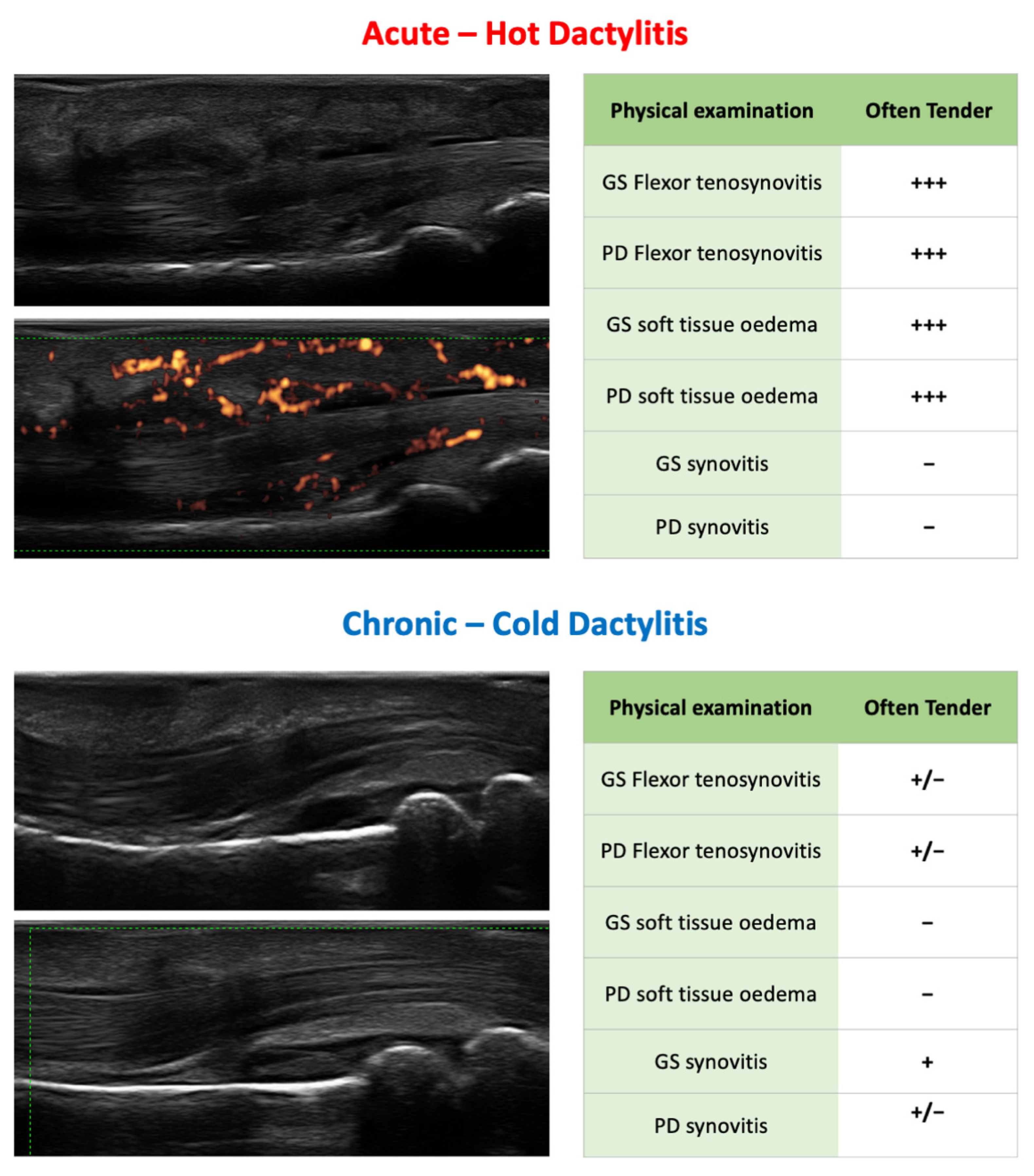 JCM | Free Full-Text | Psoriatic Dactylitis: Current Perspectives And ...