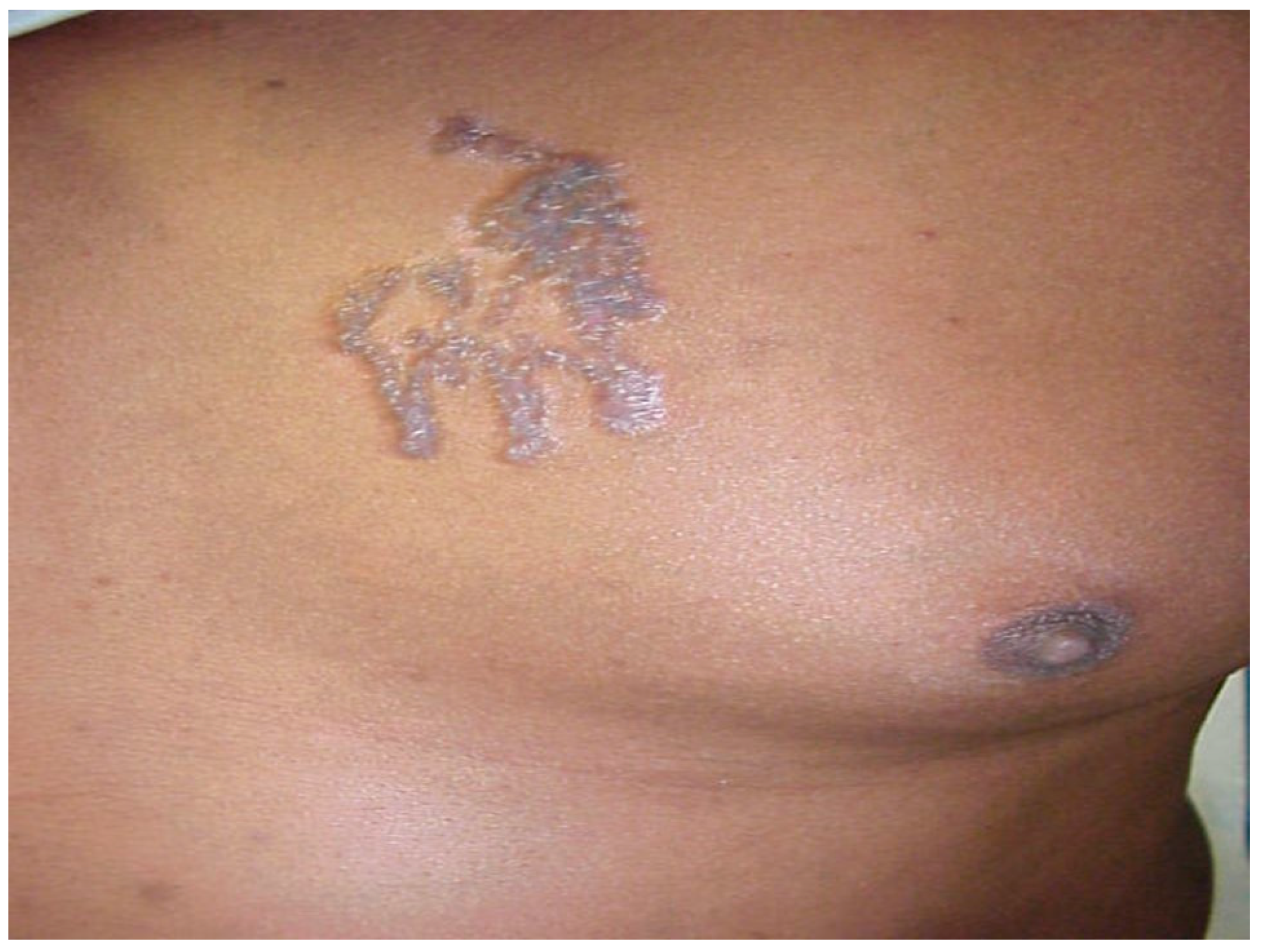 Hypersensitive Reaction to Tattoos: A Growing Menace in Rural India. -  Abstract - Europe PMC