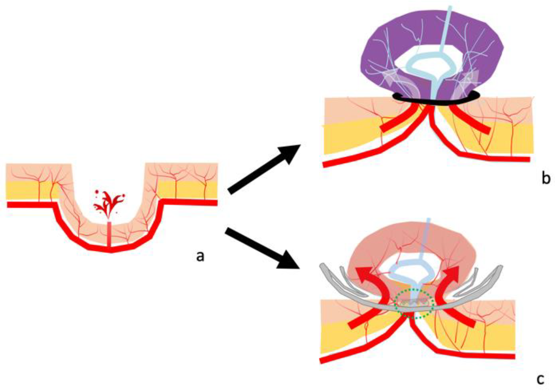 JCM | Free Full-Text | Efficacy of Over-The-Scope Clip Method as a Novel  Hemostatic Therapy for Colonic Diverticular Bleeding