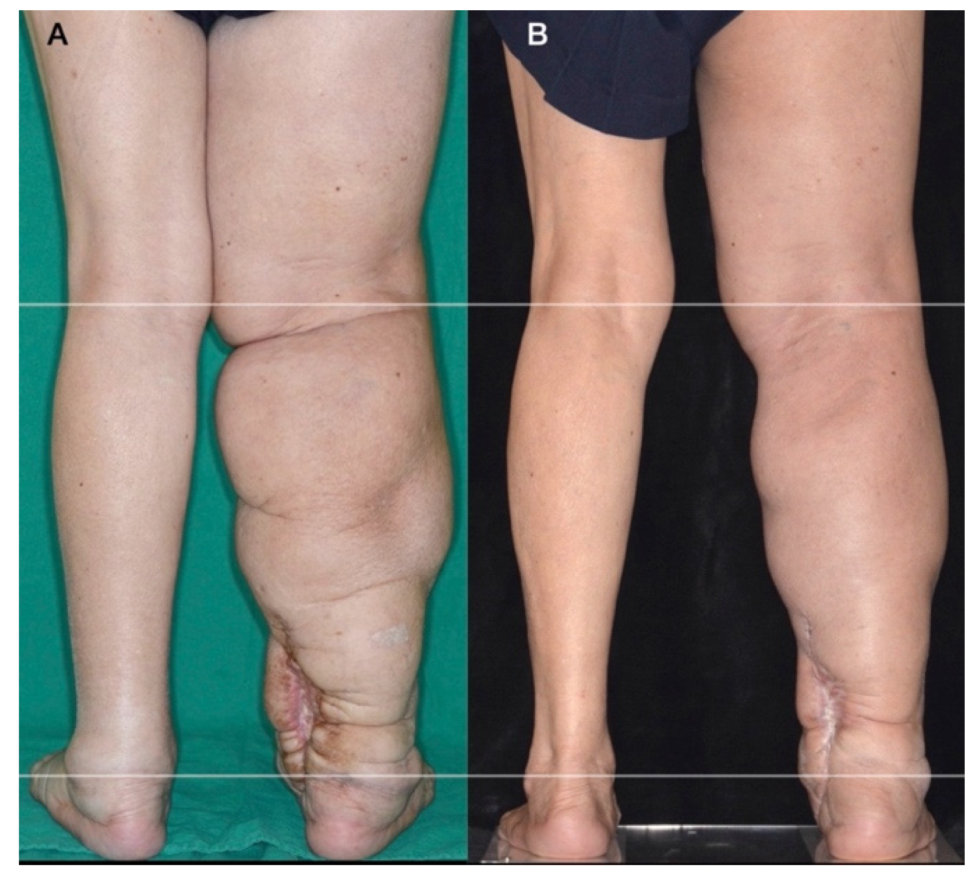 Lymphedema Causes One Leg Larger  Naples Cardiac & Endovascular Center
