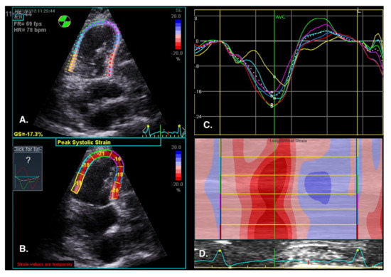 SPECKLE TRACKING RV GLOBAL LONGITUDINAL STRAIN FOR PREDICTION OF PULMONARY  HYPERTENSION - Canadian Journal of Cardiology