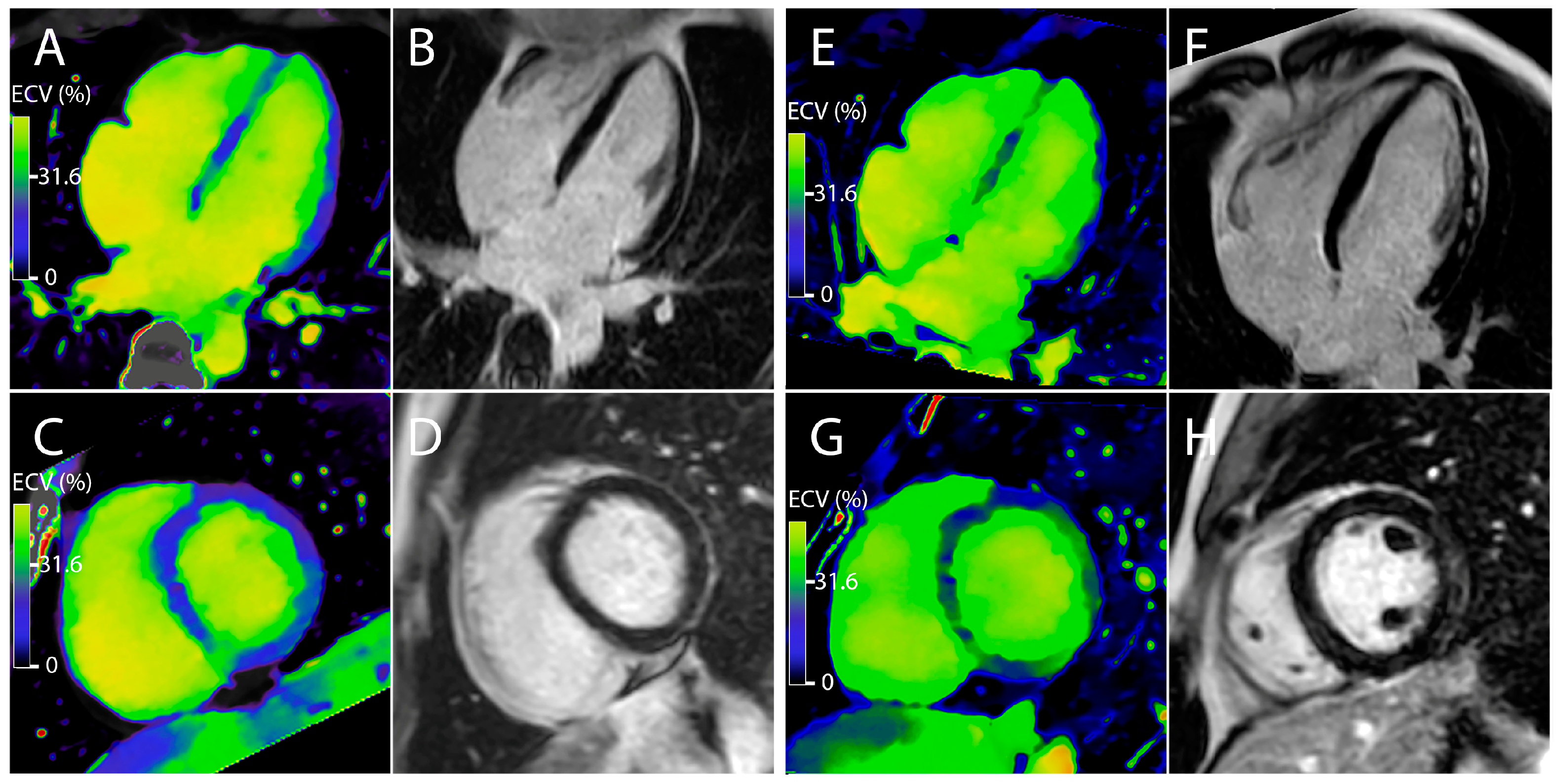 Jcm Free Full Text Diagnostic Performance Of Extracellular Volume Quantified By Dual Layer Dual Energy Ct For Detection Of Acute Myocarditis Html