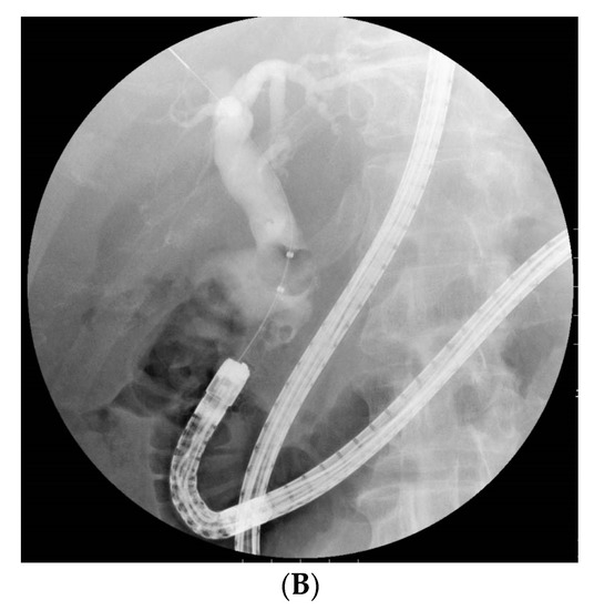 choledocholithiasis ercp