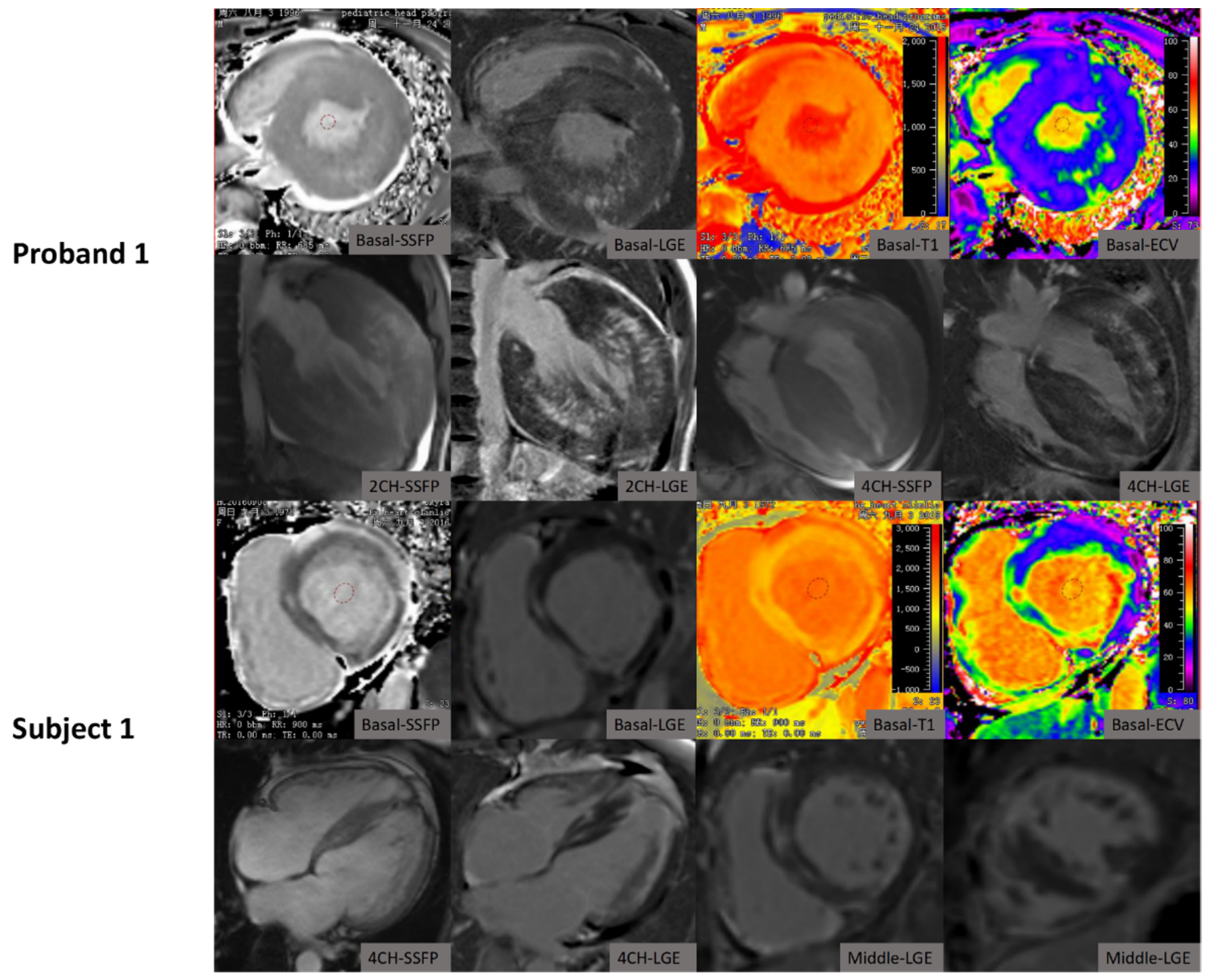 Jcm Free Full Text The Value Of Cardiac Magnetic Resonance Imaging In Identification Of Rare Diseases Mimicking Hypertrophic Cardiomyopathy Html