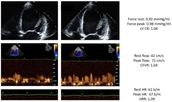 JCM | Free Full-Text | Coronary Flow, Left Ventricular Contractile and  Heart Rate Reserve in Non-Ischemic Heart Failure