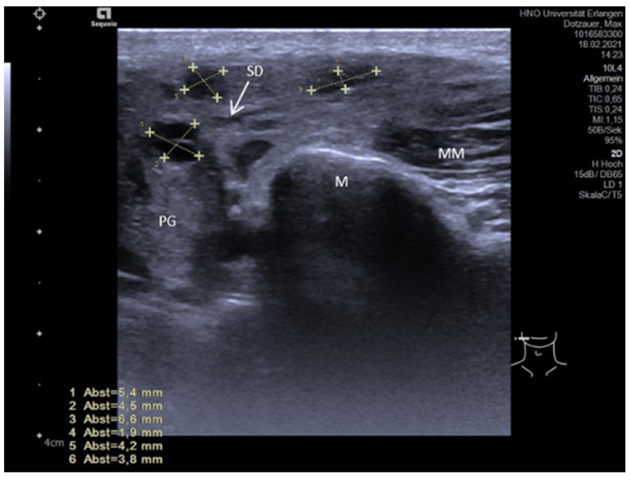 parotid gland swelling ultrasound
