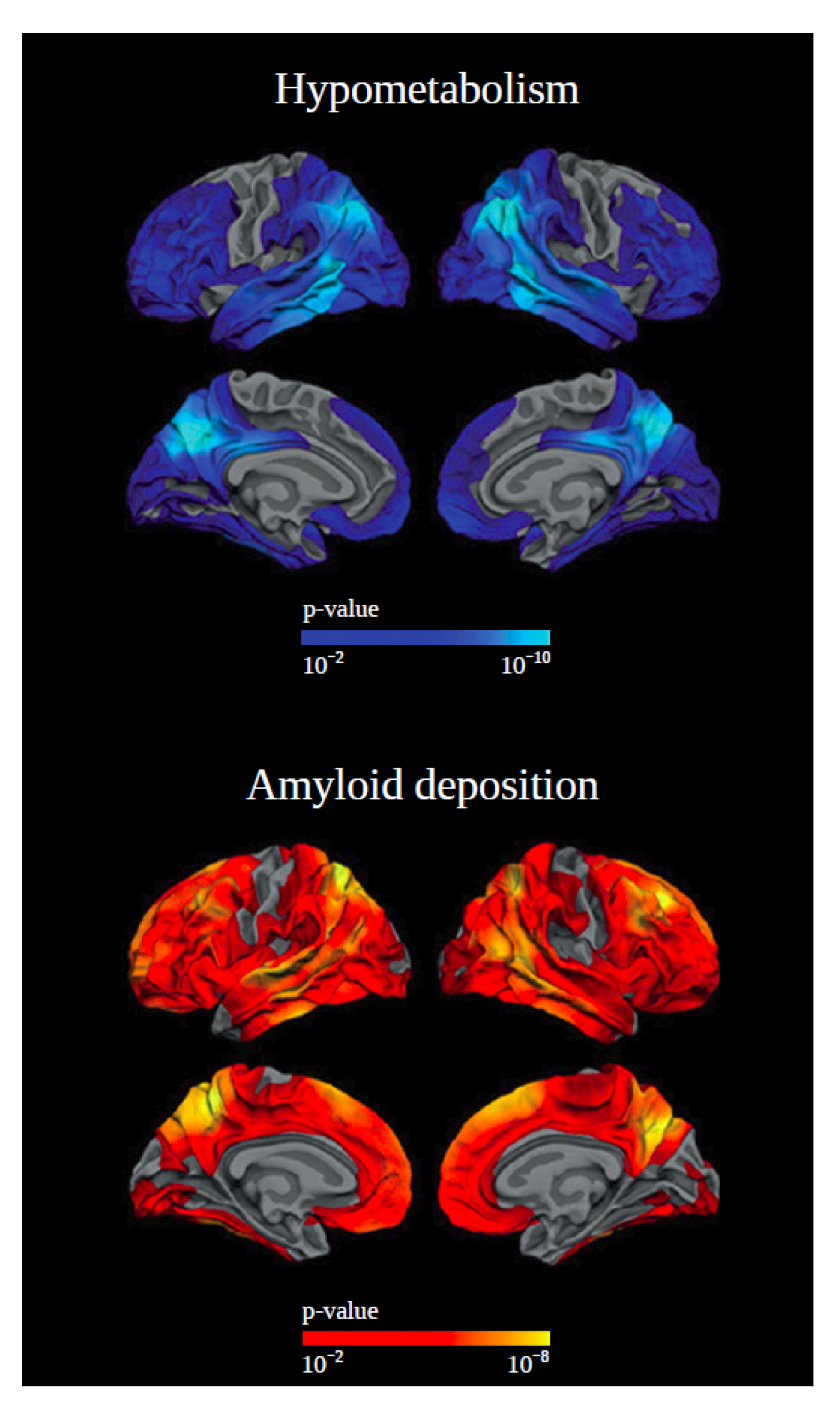 Thinking Clearly About Down Syndrome and Alzheimer's - Down Syndrome  Resource Foundation