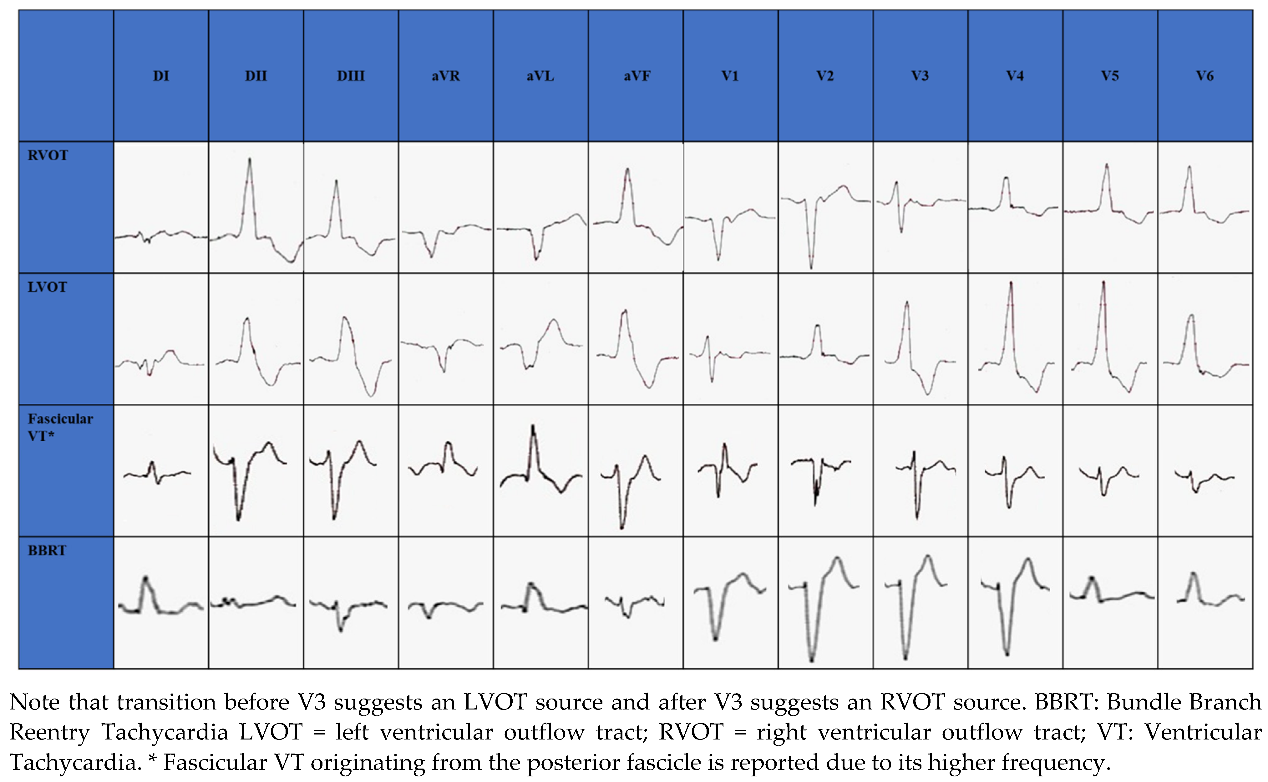 JCM | Free Full-Text | Flecainide in Ventricular Arrhythmias: From Old  Myths to New Perspectives