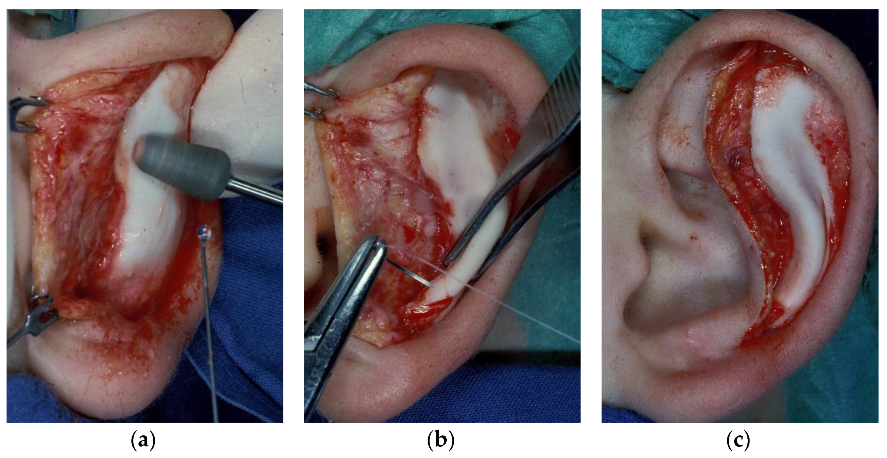 JCM | Free Full-Text | Otoplasty through Ventral Skin Incision and Shaping  of the Antihelix by Abrasion—A Retrospective Study