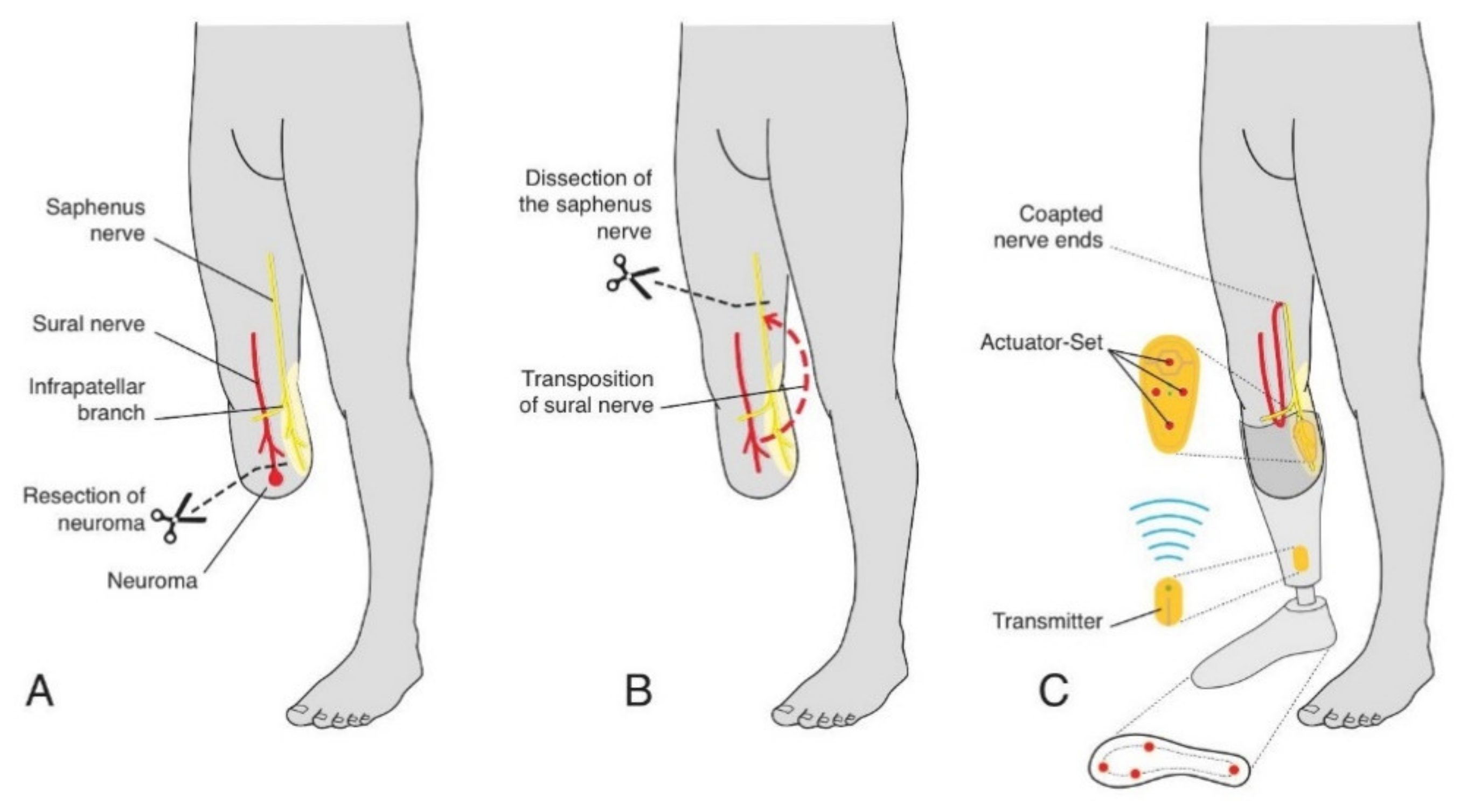 Leg Pain Amputation Risk