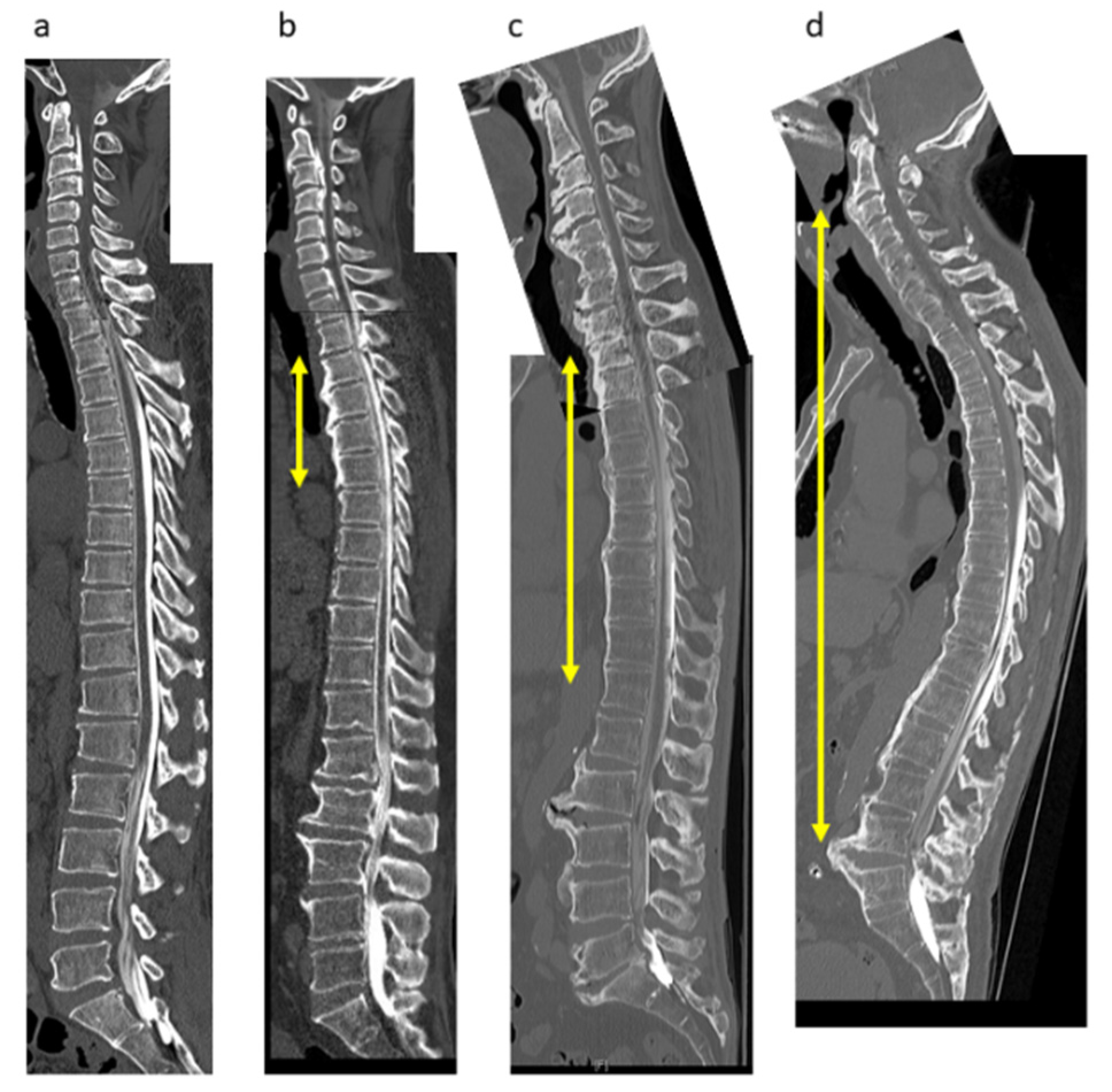 diffuse idiopathic skeletal hyperostosis cervical spine