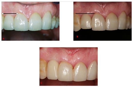 JCM | Free Full-Text | 3D Considerations and Outcomes of Immediate ...