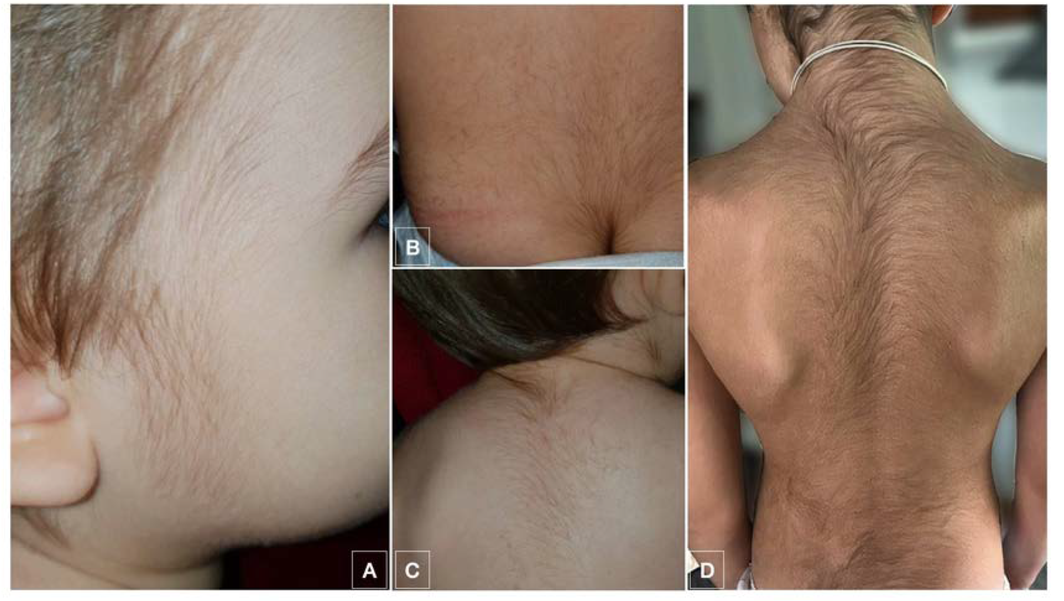 JCM | Free Full-Text | Systemic Minoxidil Accidental Exposure in a  Paediatric Population: A Case Series Study of Cutaneous and Systemic Side  Effects | HTML