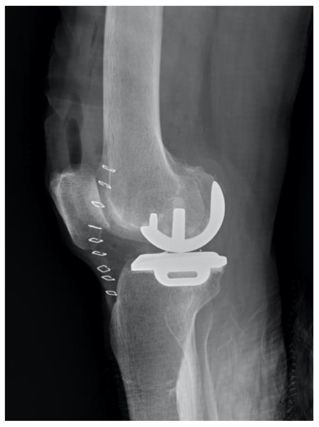 JCM | Free Full-Text | Using MRI Measurement to Improve Accuracy of Femoral  Component Sizing in Oxford Unicompartmental Knee Arthroplasty