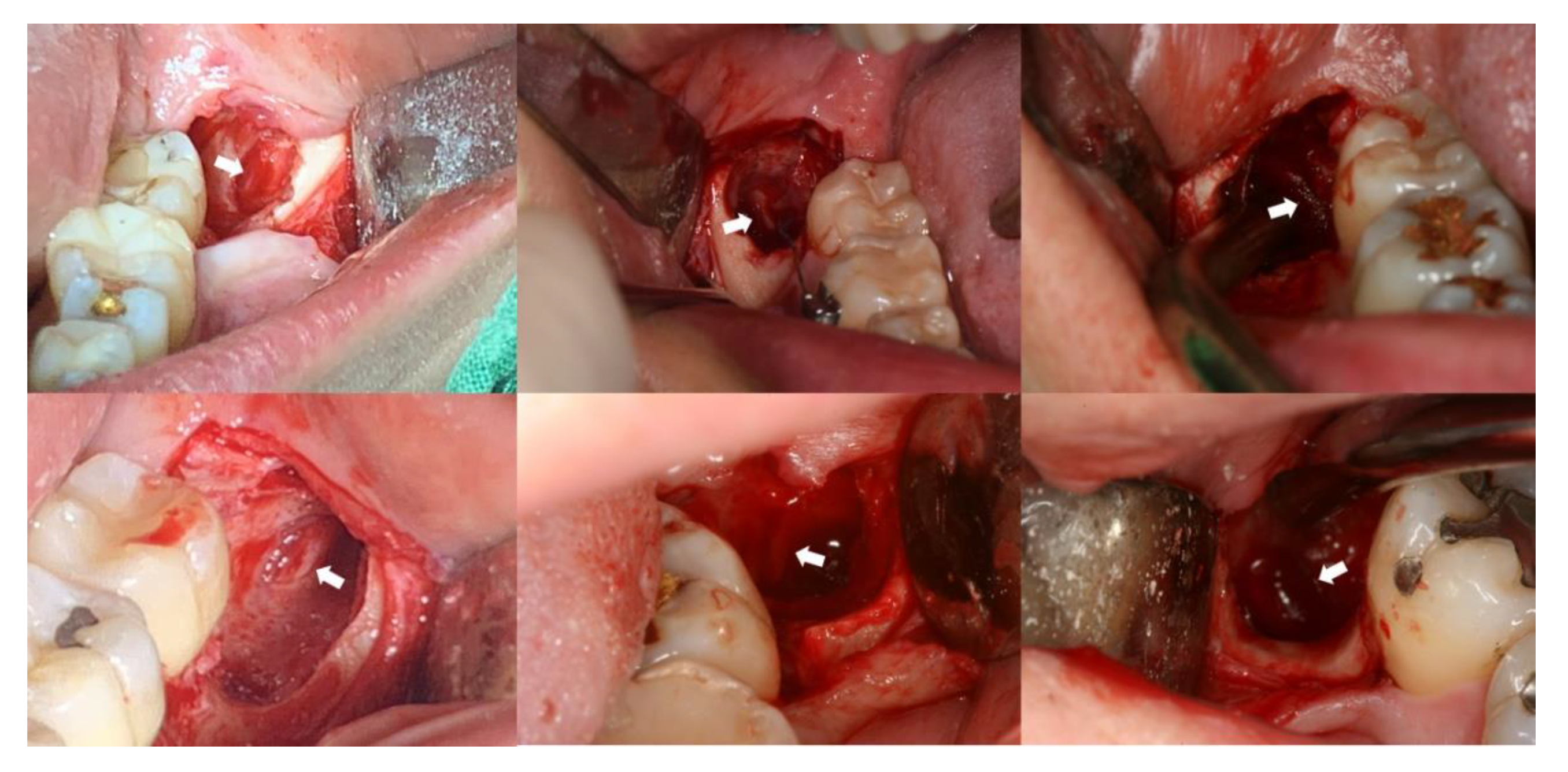 Intraoperative image of the extraction of multiple blood clots.