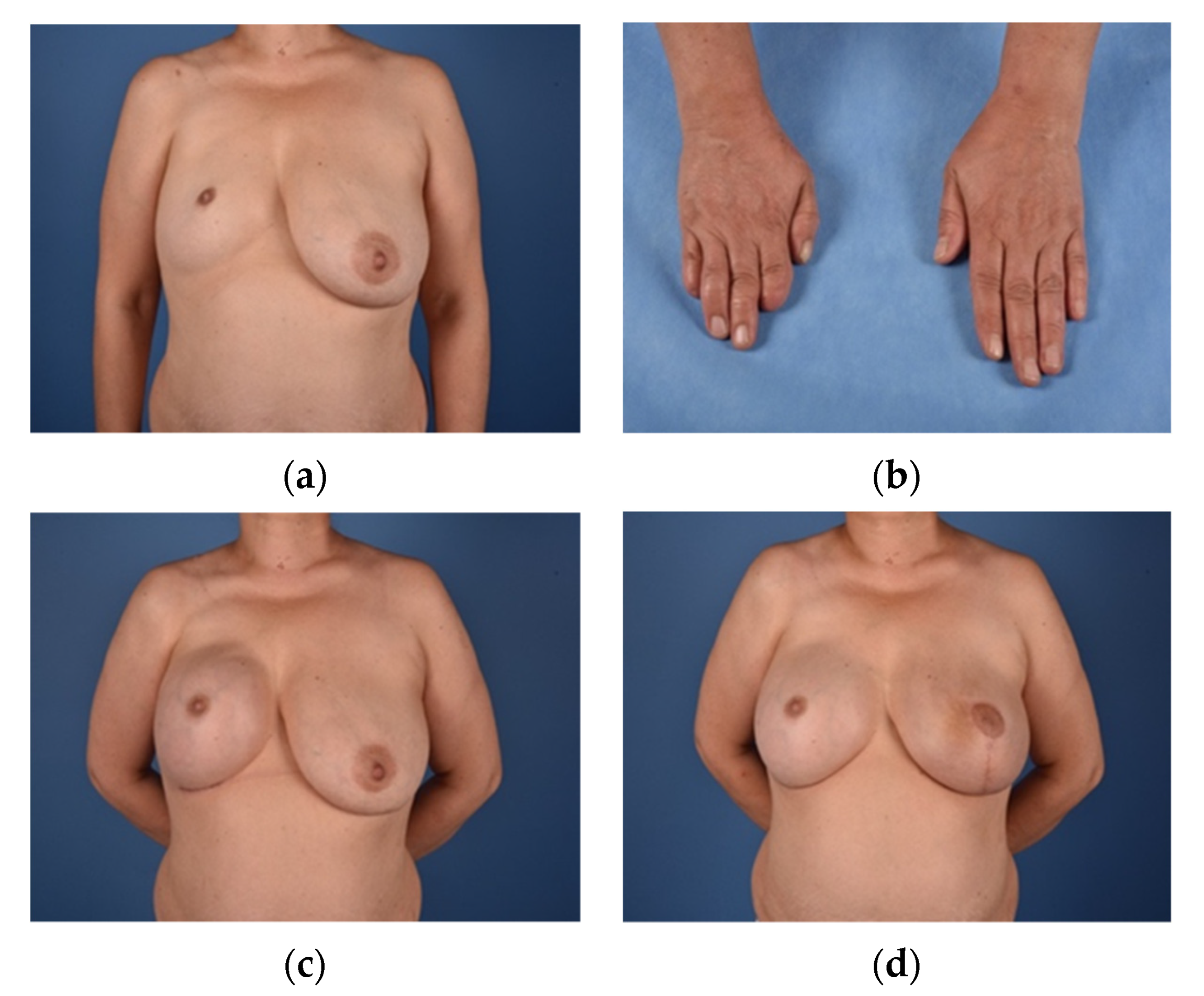 JCM | Free Full-Text | Development of A Surgical Treatment Algorithm for  Breast Reconstruction in Poland Syndrome Patients Considering Severity, Sex,  and BMI