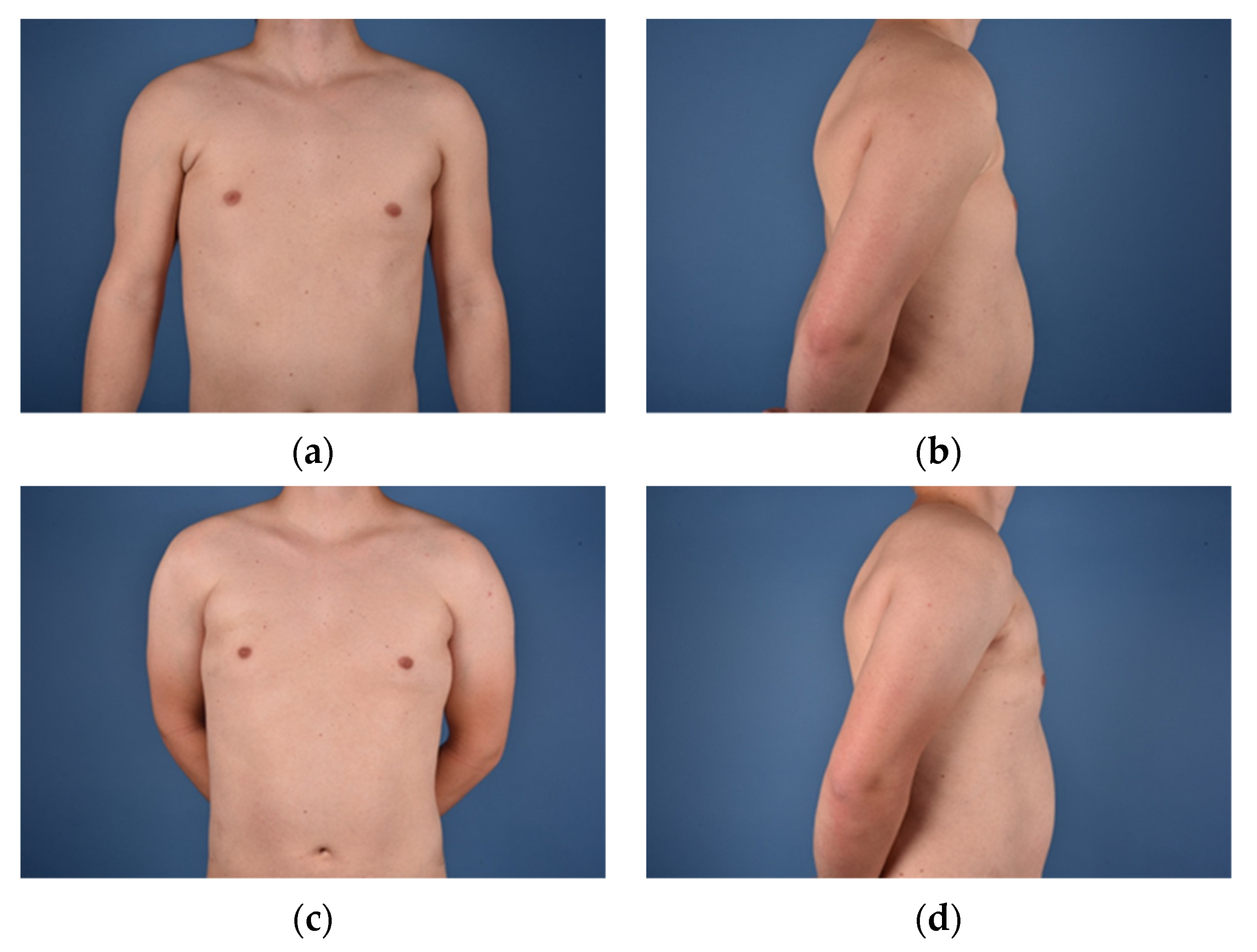 Asymmetrical Breasts Associated with Chest Deformities
