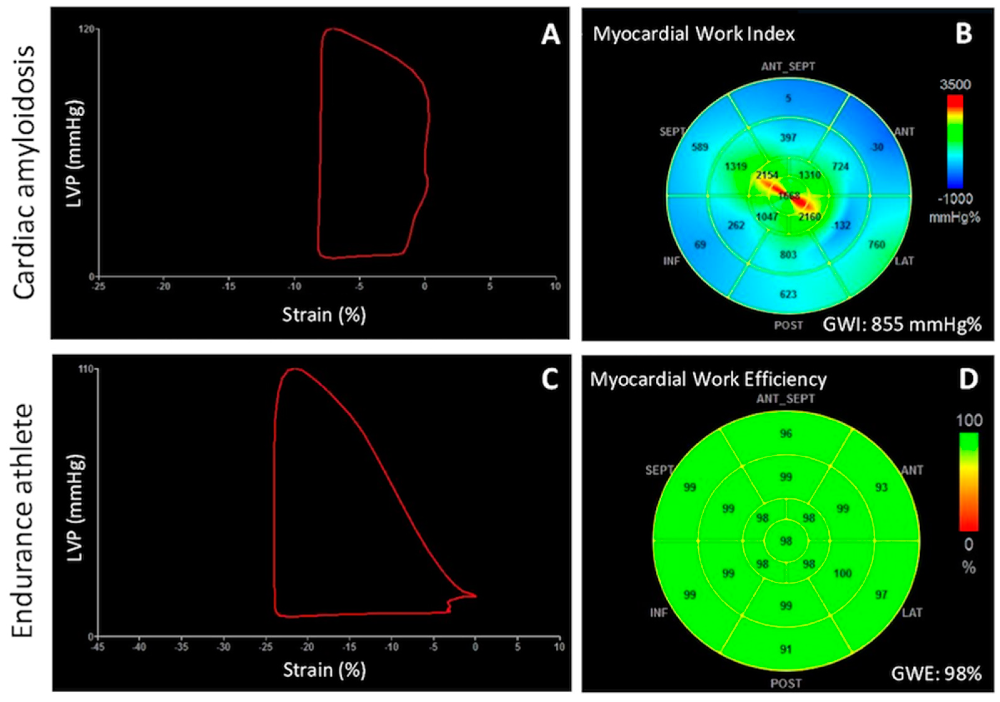 Practical assessment of myocardial work. a Global longitudinal strain