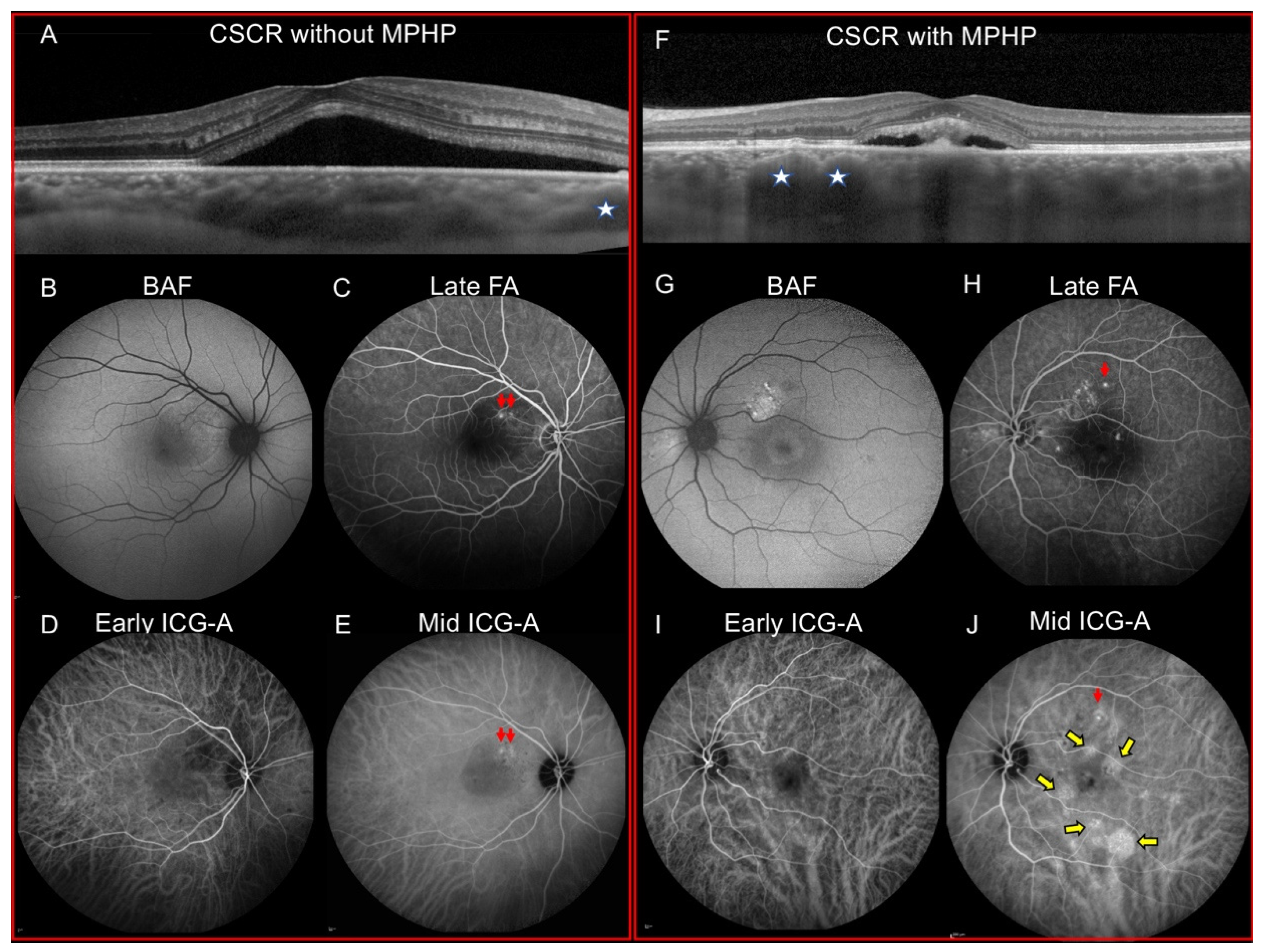 JCM | Free Full-Text | Mid-Phase Hyperfluorescent Plaques Seen on  Indocyanine Green Angiography in Patients with Central Serous  Chorioretinopathy | HTML