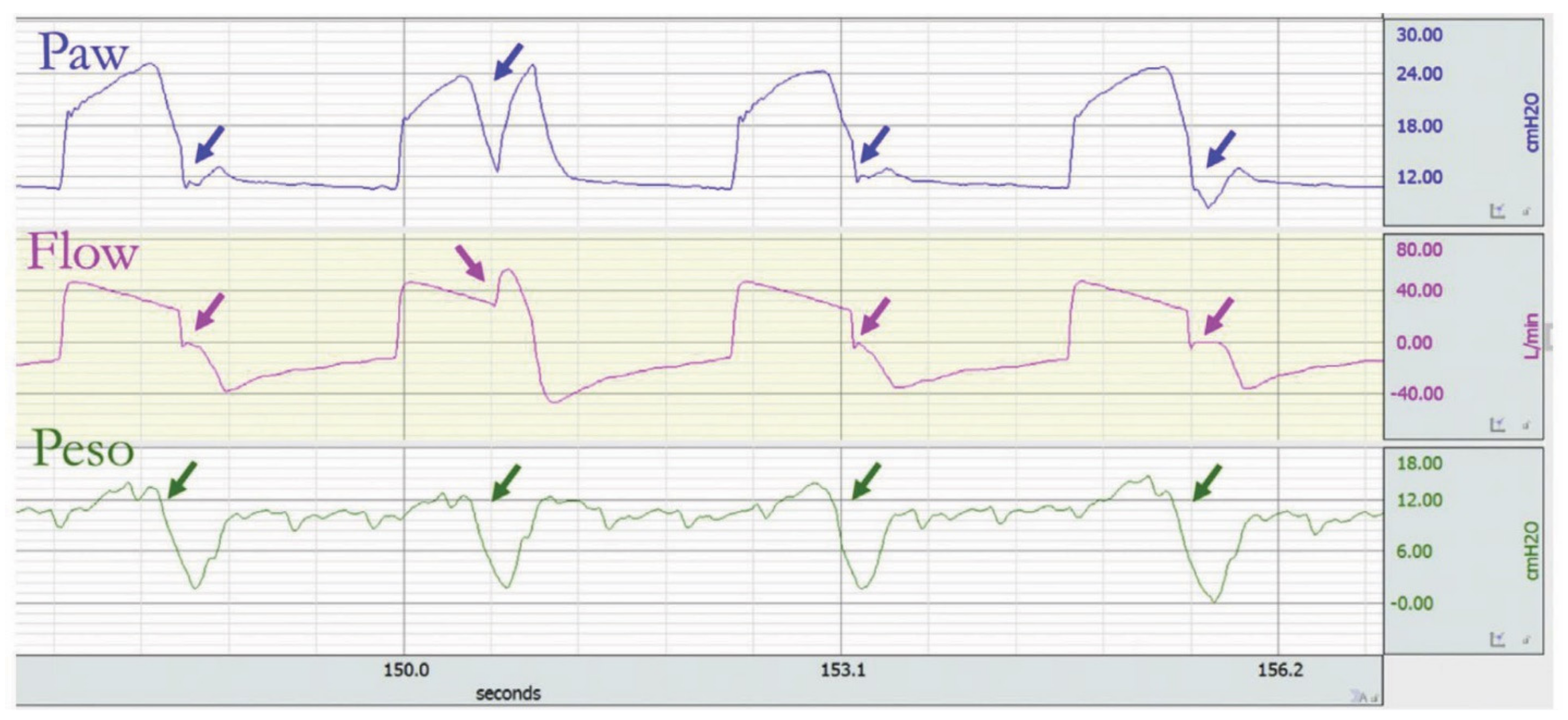 JCM | Free Full-Text | Patient–Ventilator Dyssynchrony in Critically Ill  Patients