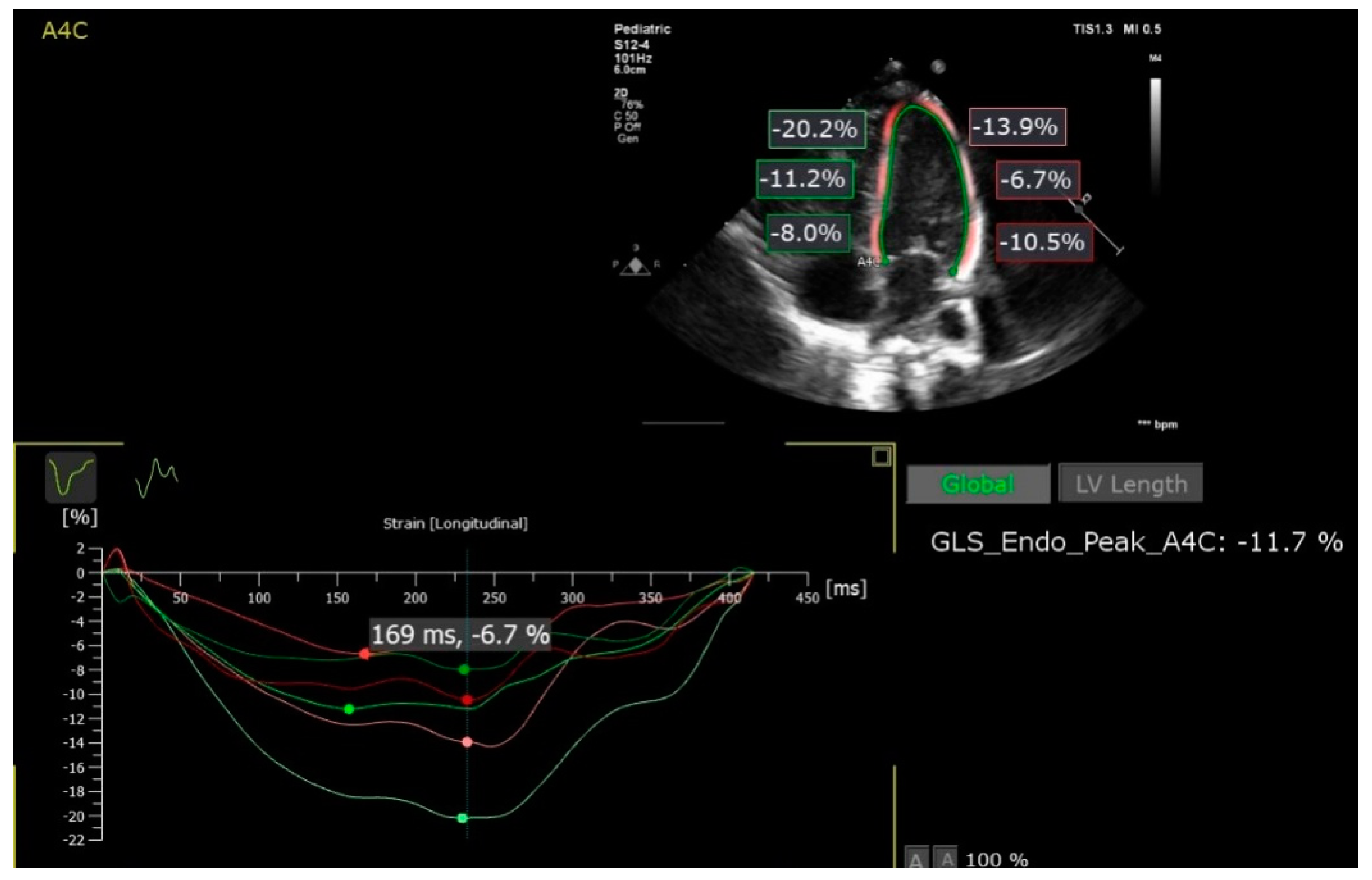 Longitudinal strain by two-dimensional speckle tracking to assess  ventricular function in adults with transposition of the great arteries:  Can serial assessment be simplified?