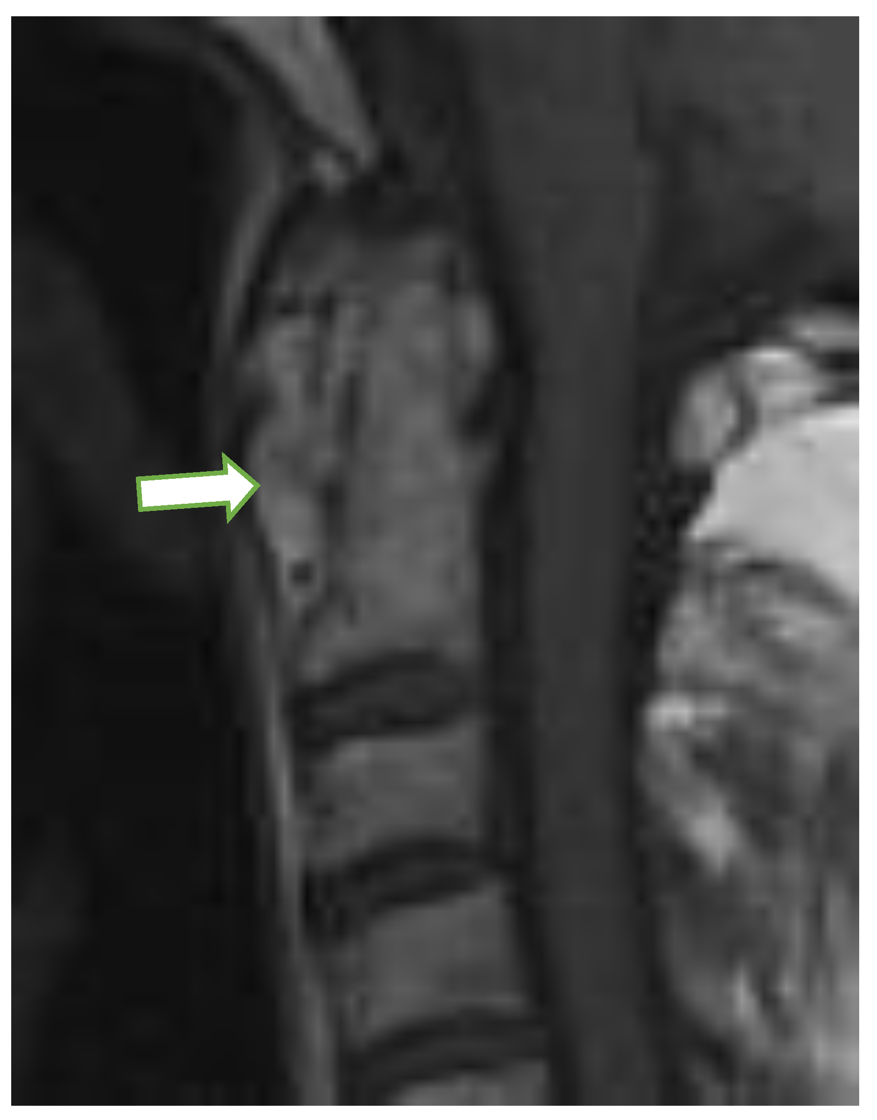 Jcm Free Full Text Radiological Evaluation Of Cervical Spine Involvement In Rheumatoid