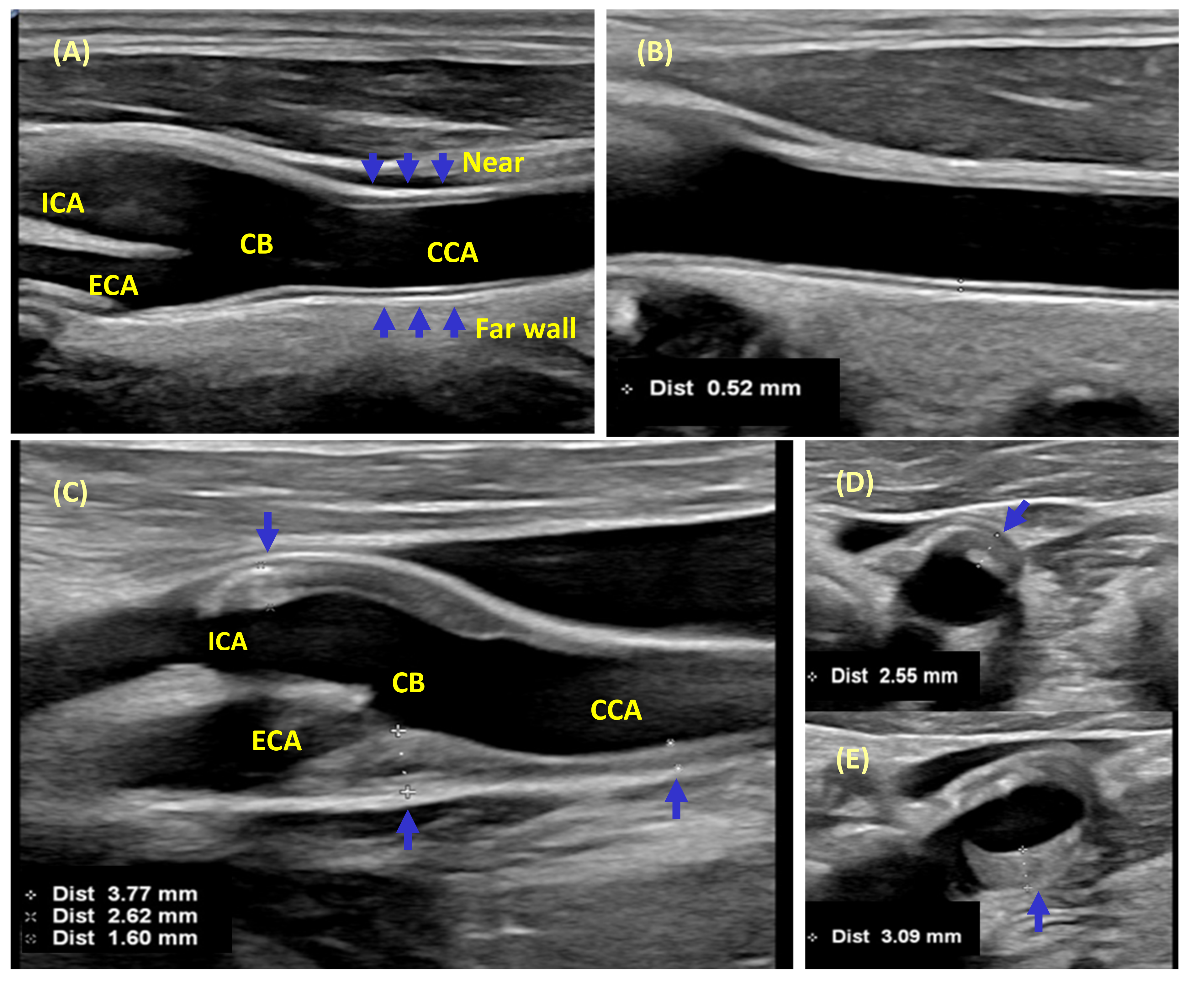 JCM | Free Full-Text | Clinical Significance of Carotid Intima-Media  Complex and Carotid Plaque Assessment by Ultrasound for the Prediction of  Adverse Cardiovascular Events in Primary and Secondary Care Patients