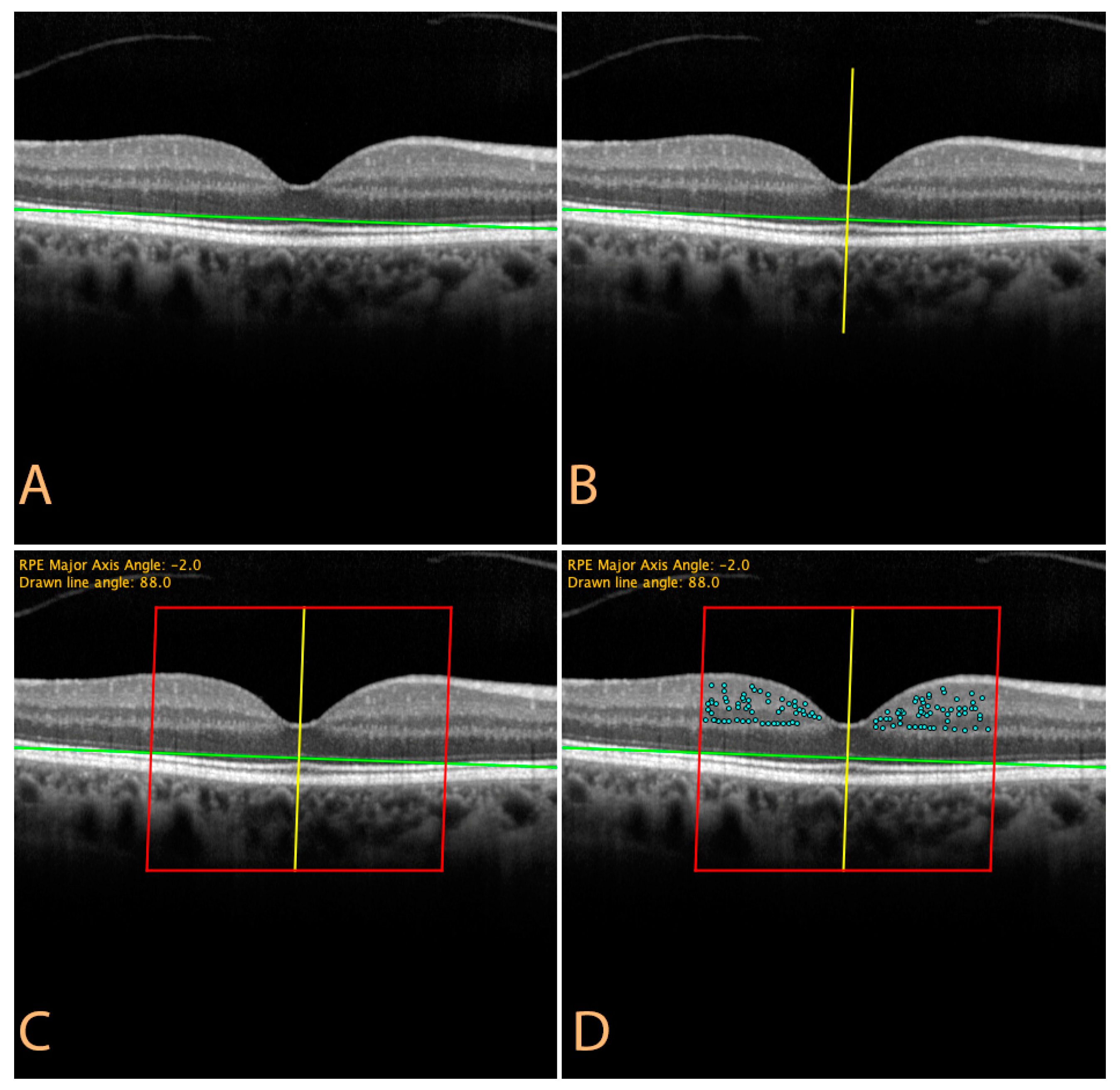 JCM | Free Full-Text | A Comparison of Hyper-Reflective Retinal Spot Counts  in Optical Coherence Tomography Images from Glaucomatous and Healthy Eyes