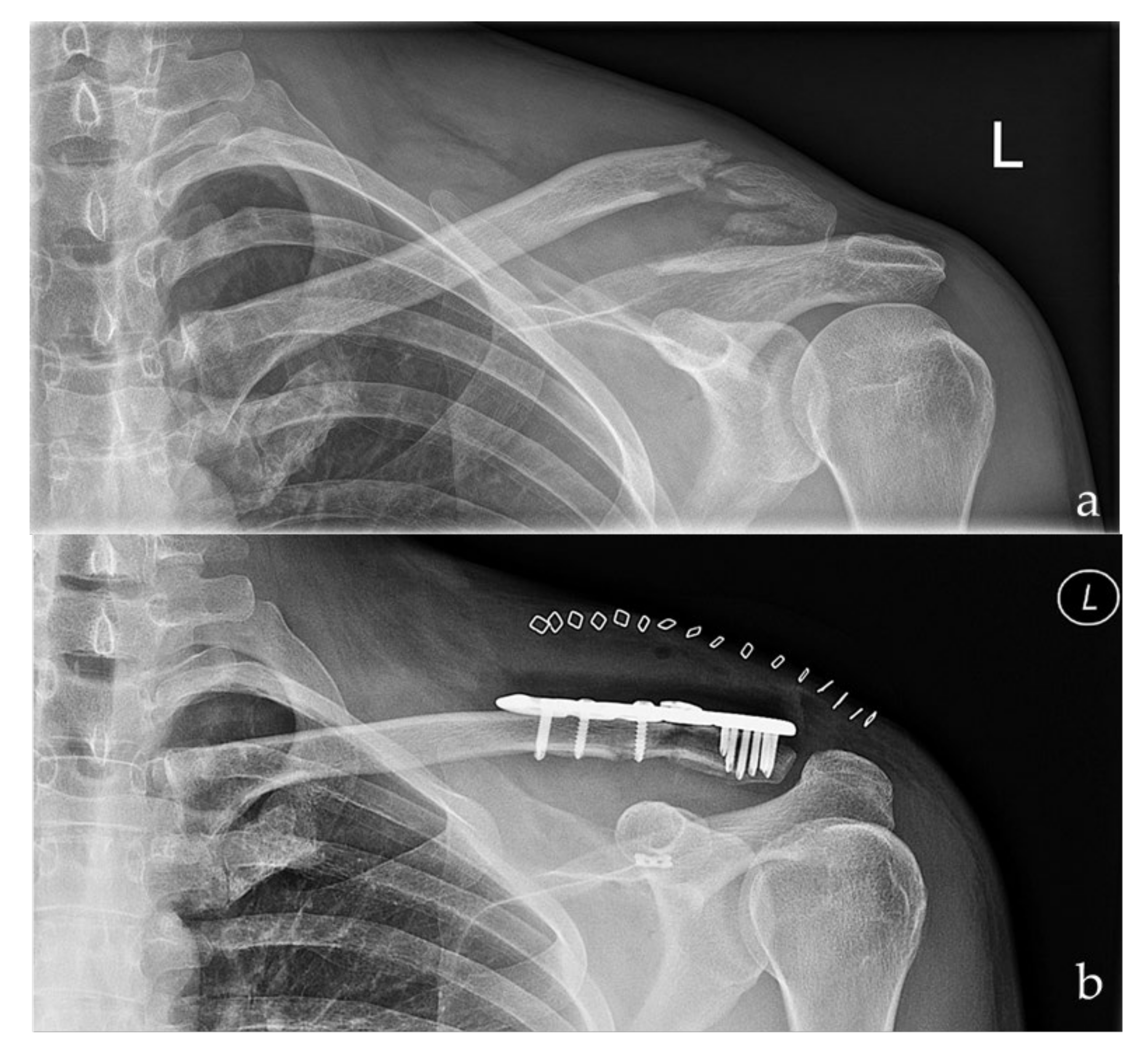 JCM | Free Full-Text | Good to Excellent Functional Outcome and High Return  to Sports Rate after Operative Treatment of Unstable Lateral Clavicle  Fractures: Comparison of Two Coracoclavicular Button Fixation Techniques