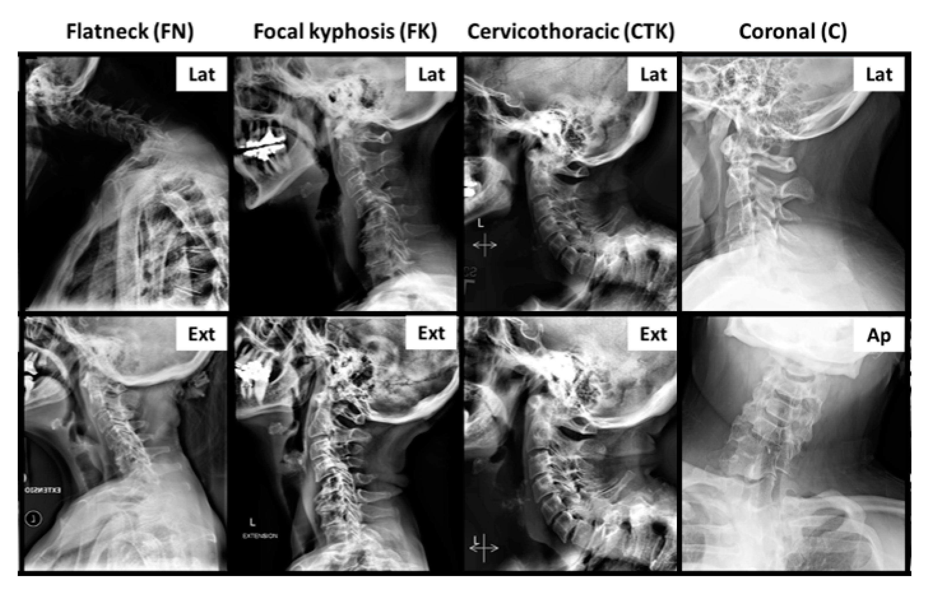 Physical Effects of Unilateral Mastectomy on Spine Deformity - ScienceDirect