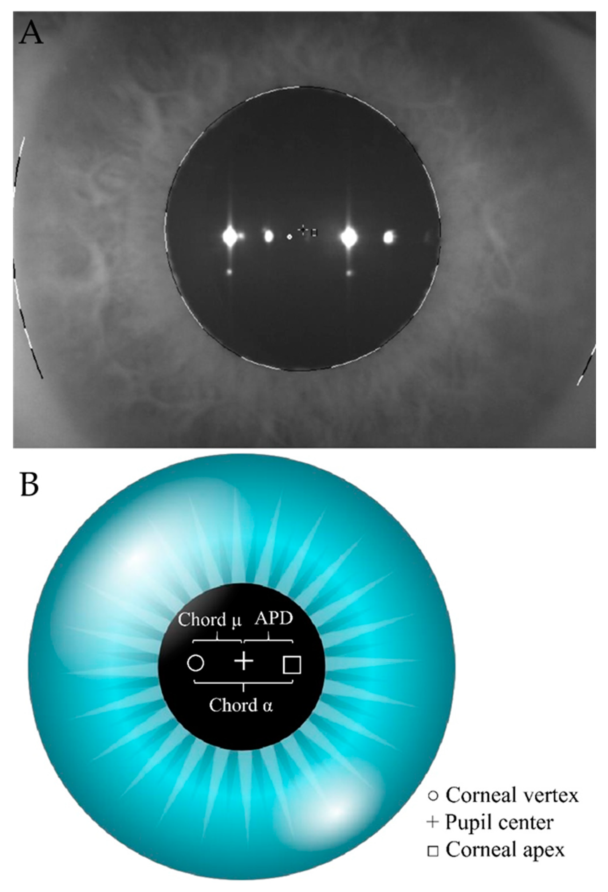 JCM | Free Full-Text | Chord Mu (µ) and Chord Alpha (α) Length Changes in  Fuchs Endothelial Corneal Dystrophy before and after Descemet Membrane  Endothelial Keratoplasty (DMEK) Surgery