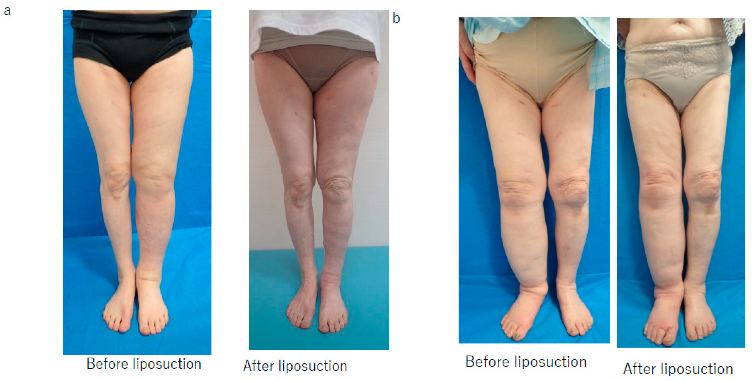 JCM | Free Full-Text | Effect of Postoperative Compression Therapy on the  Success of Liposuction in Patients with Advanced Lower Limb Lymphedema