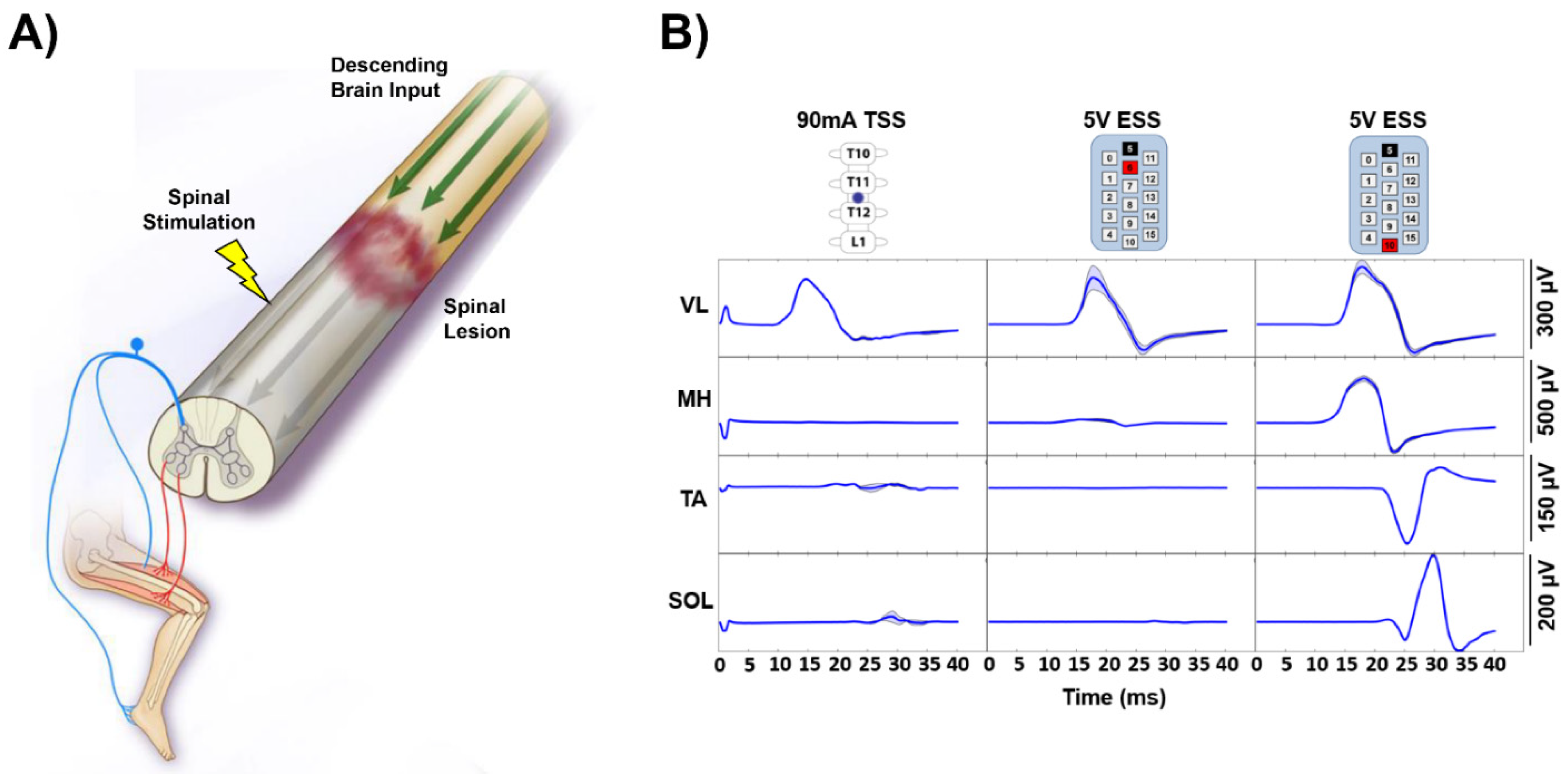 Epidural Spinal Cord Stimulation