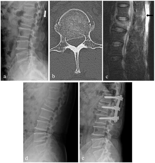 Vertebral Compression Fracture - Atlanta, GA - Spine Surgery