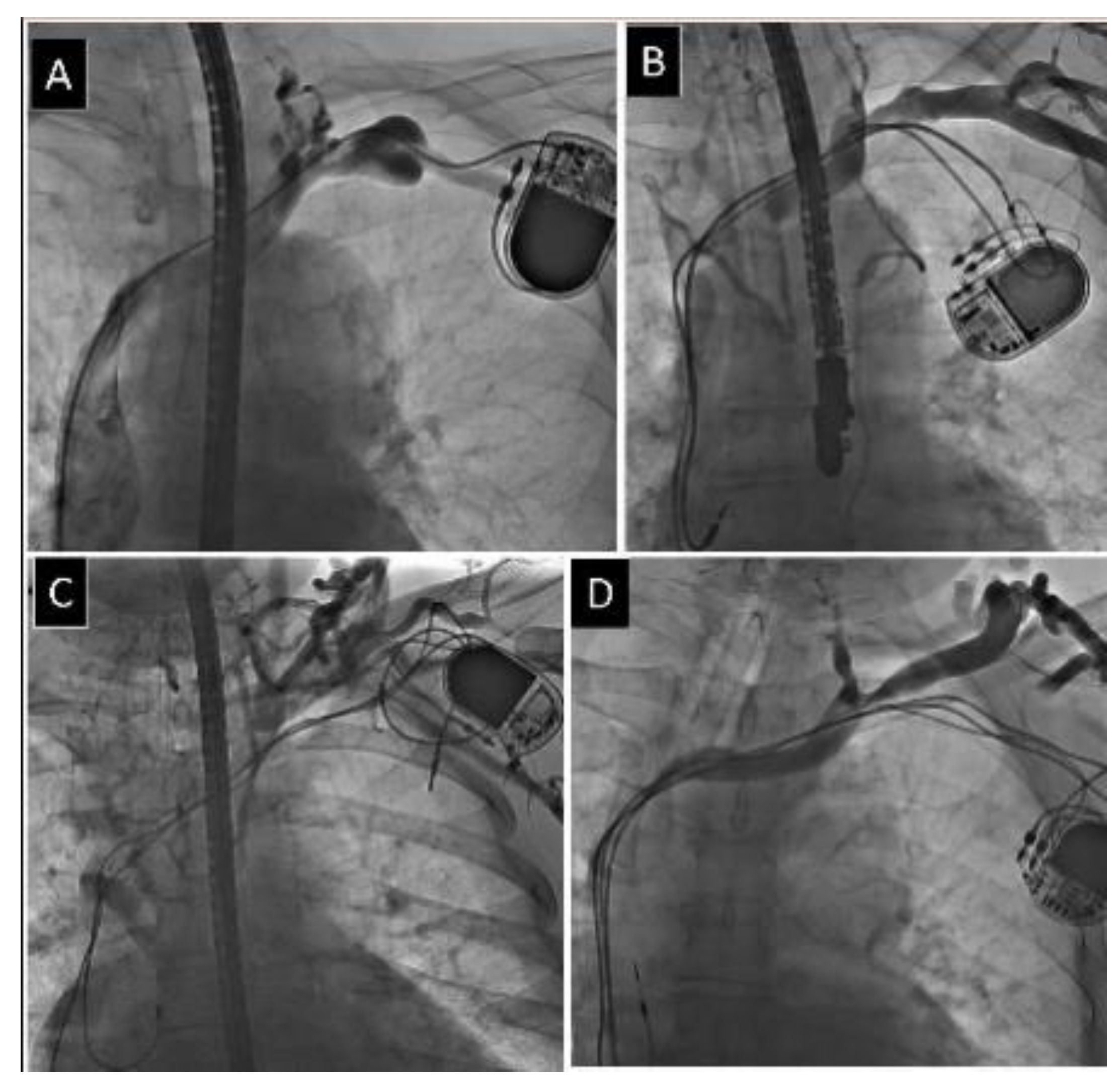 venogram venous occlusive disease