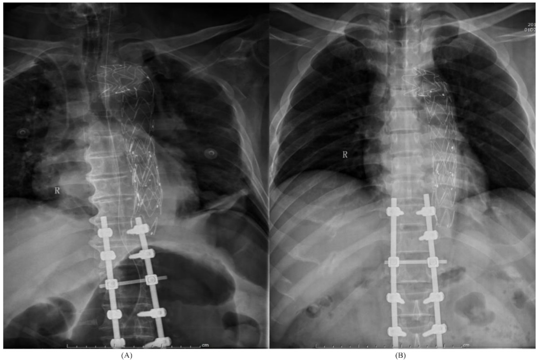 Thoracic Spine Fractures & Injuries