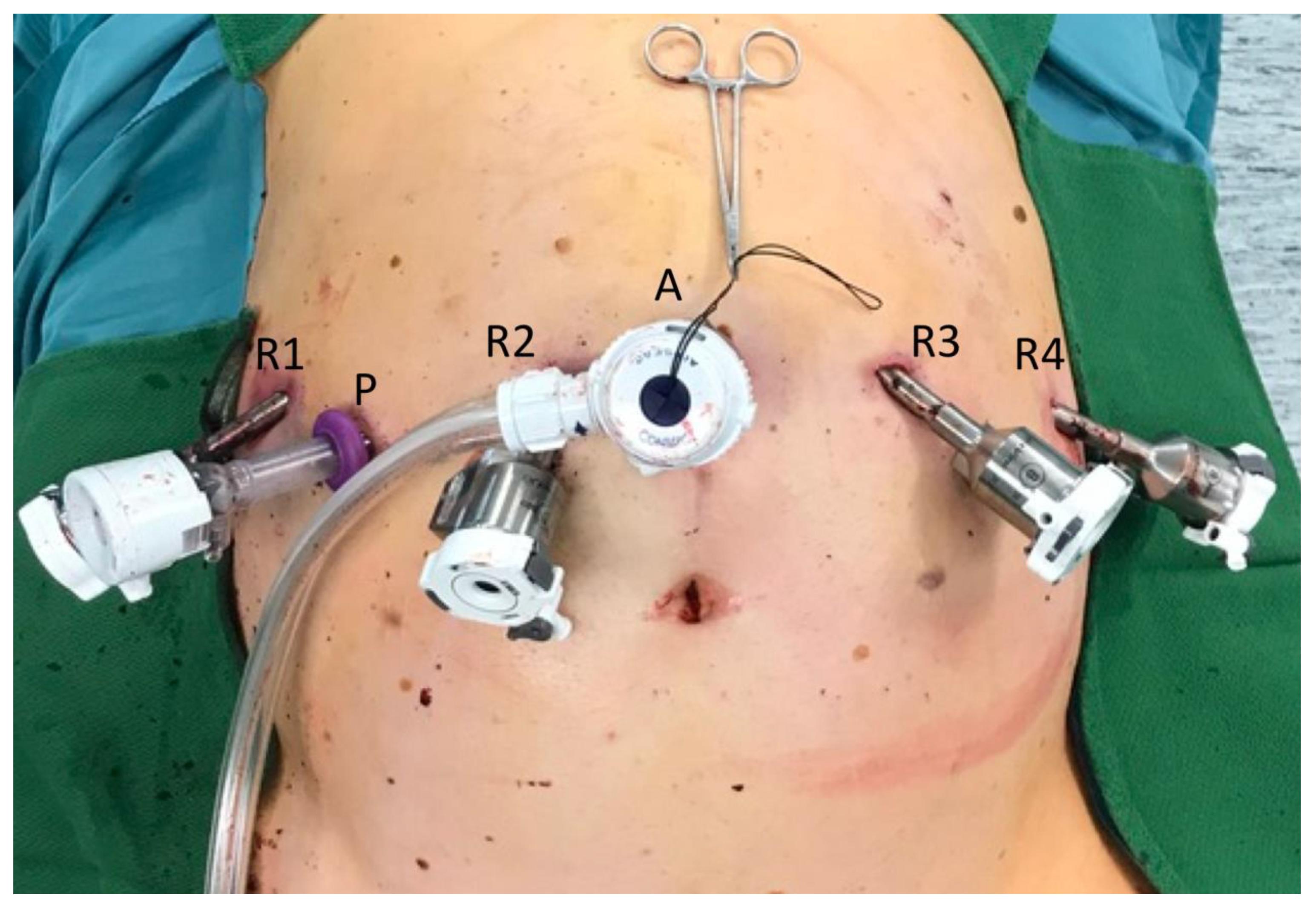 JCM | Free Full-Text | Three-Device (3D) Technique for Liver Parenchyma  Dissection in Robotic Liver Surgery | HTML