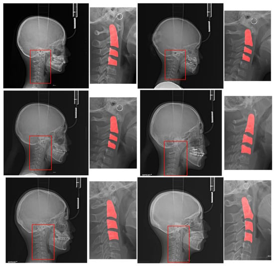 JCM Free Full Text Estimating Cervical Vertebral Maturation