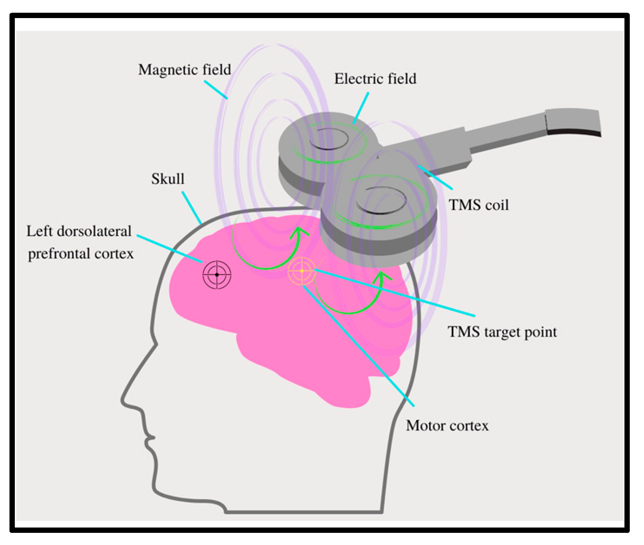 JCM | Free Full-Text | Implications of Transcranial Magnetic Stimulation as  a Treatment Modality for Tinnitus