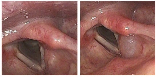 JCM | Free Full-Text | Supraglottic Botulinum Toxin Improves Symptoms in  Patients with Laryngeal Sensory Dysfunction Manifesting as Abnormal Throat  Sensation and/or Chronic Refractory Cough