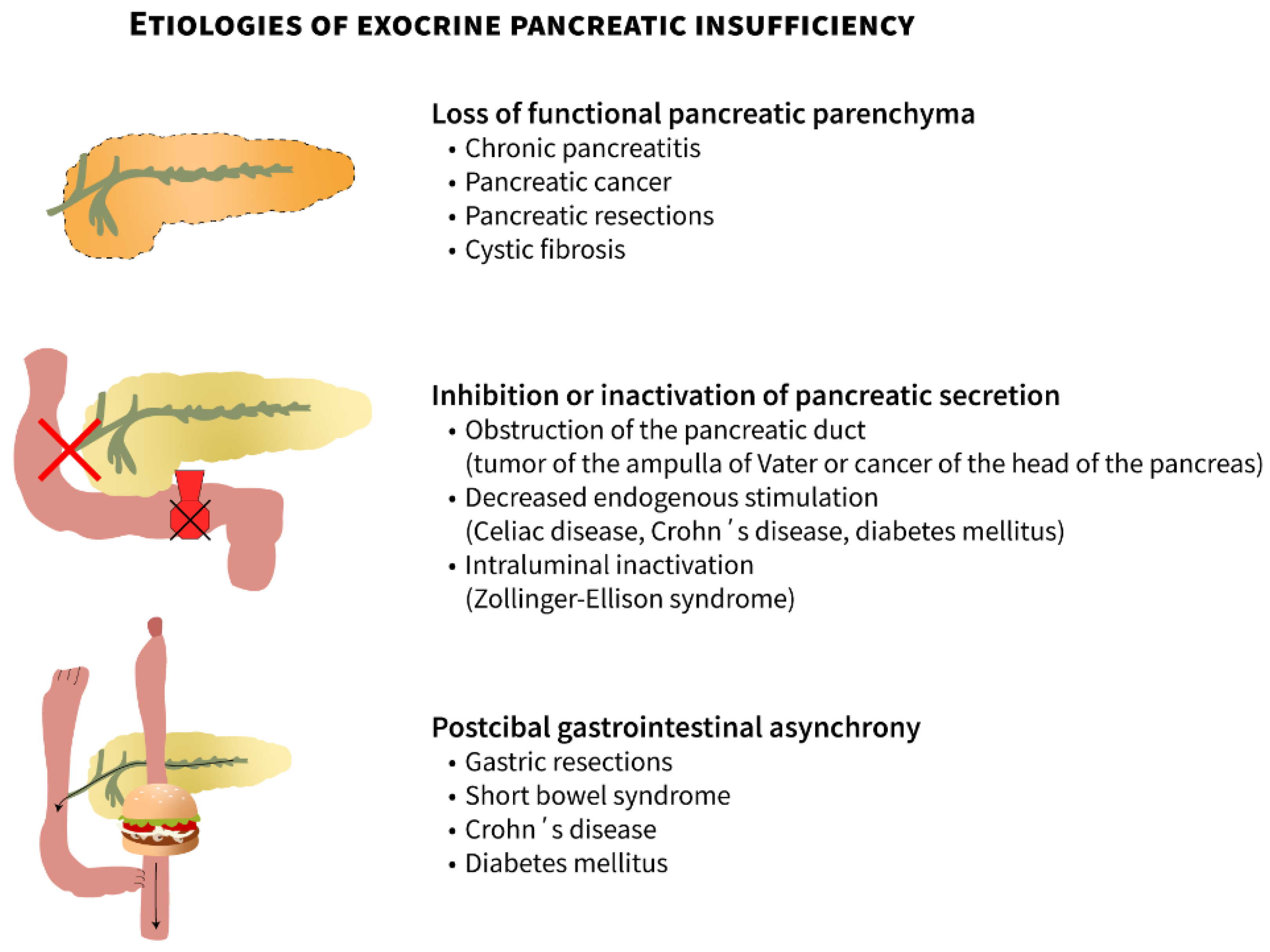 JCM | Free Full-Text | Causes of Exocrine Pancreatic Insufficiency Other  Than Chronic Pancreatitis | HTML