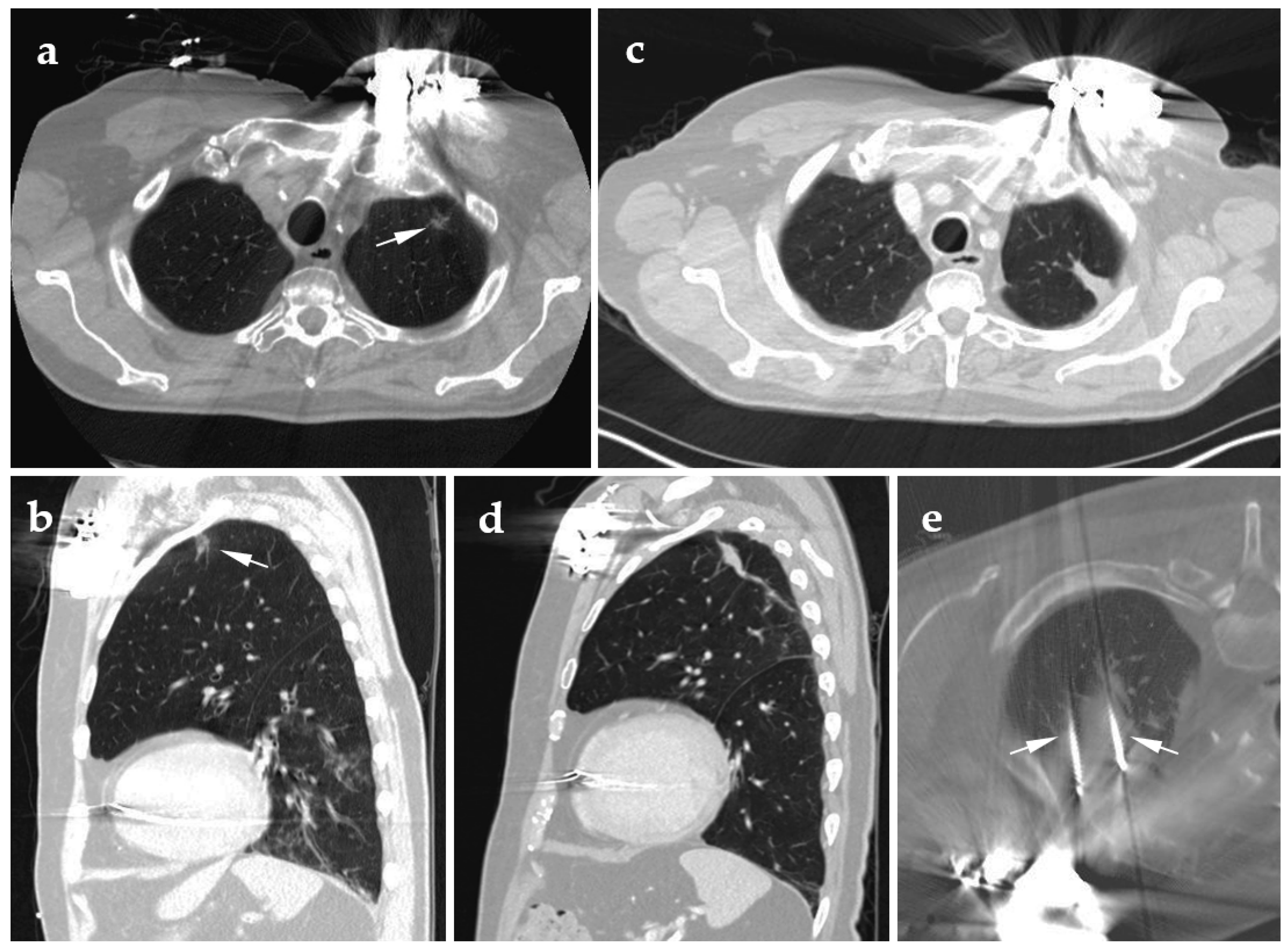 JCM | Free Full-Text | Percutaneous Image-Guided Ablation of Lung Tumors