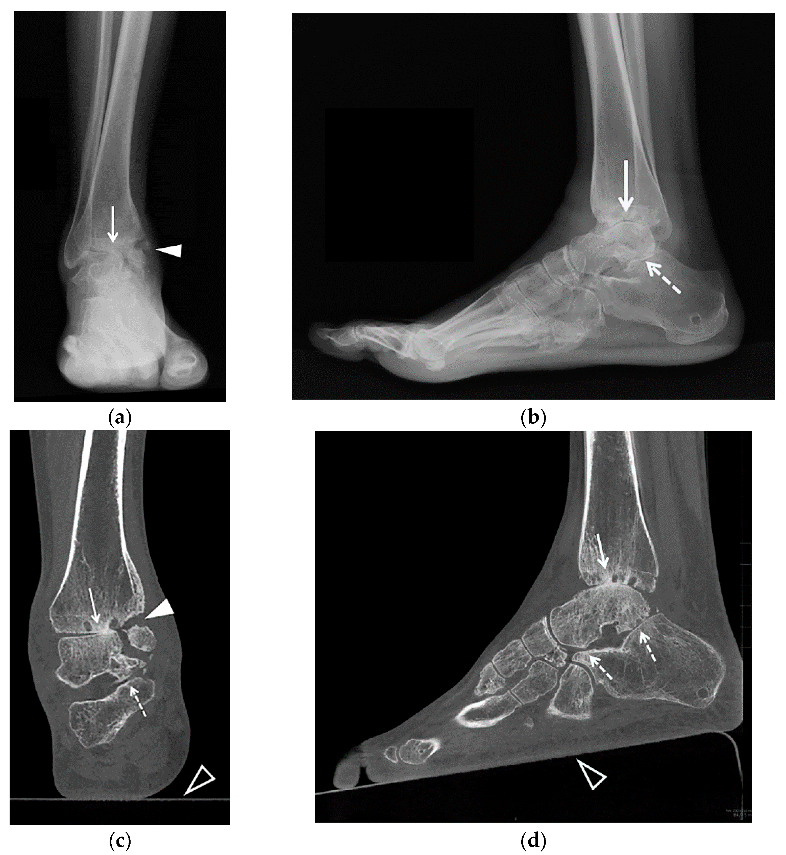 Current Concepts In Managing Diabetic Ankle Fractures