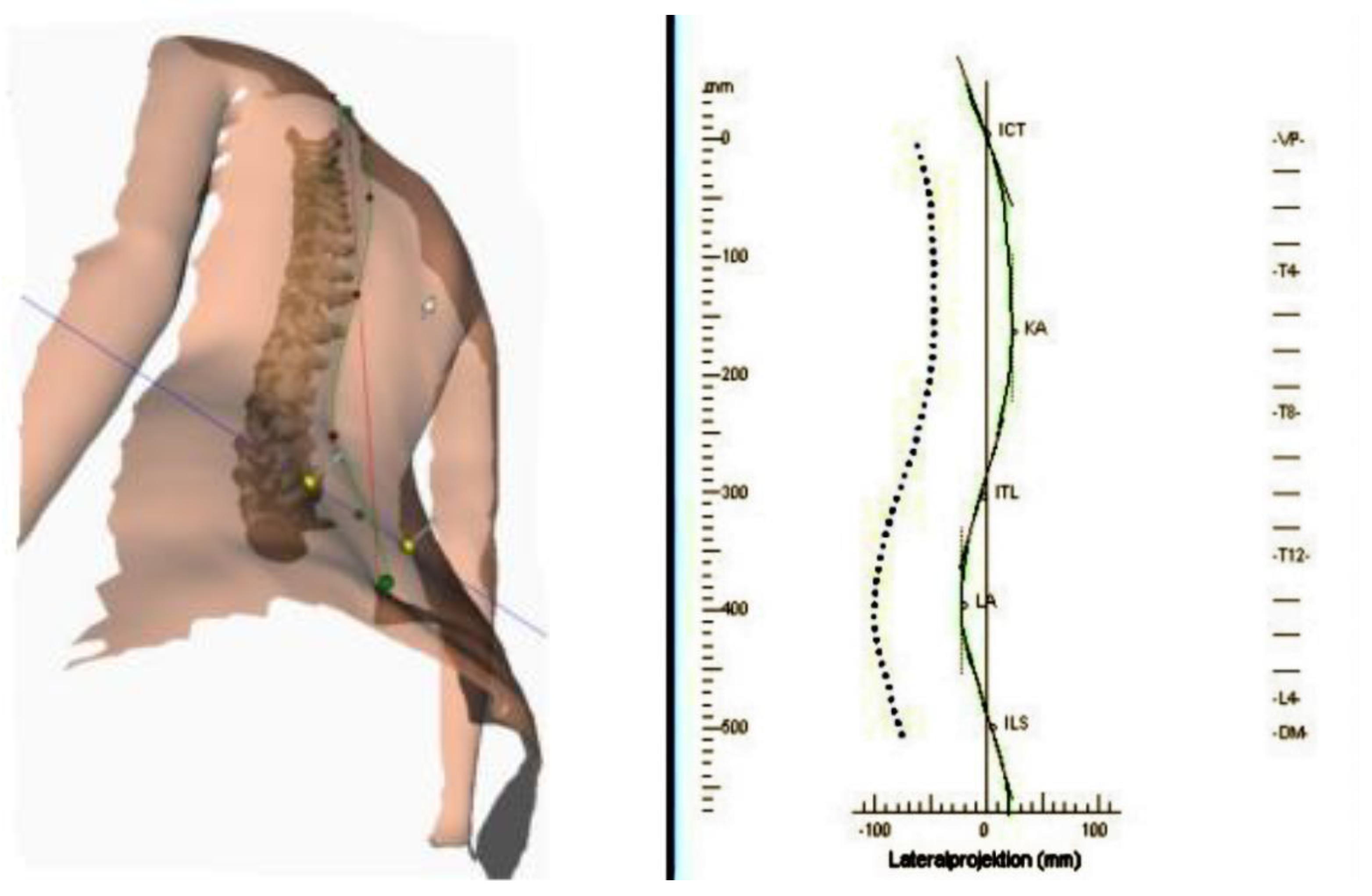 SSS thoraco-lumbar scoliosis model