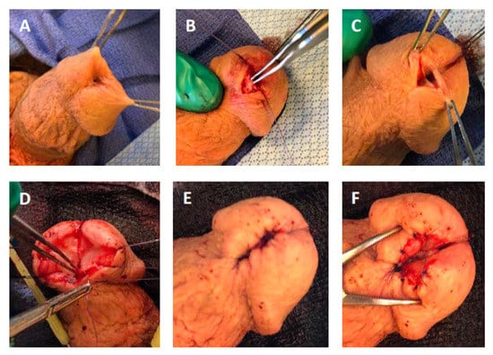 How to manage the scar tissue after cosmetic surgery