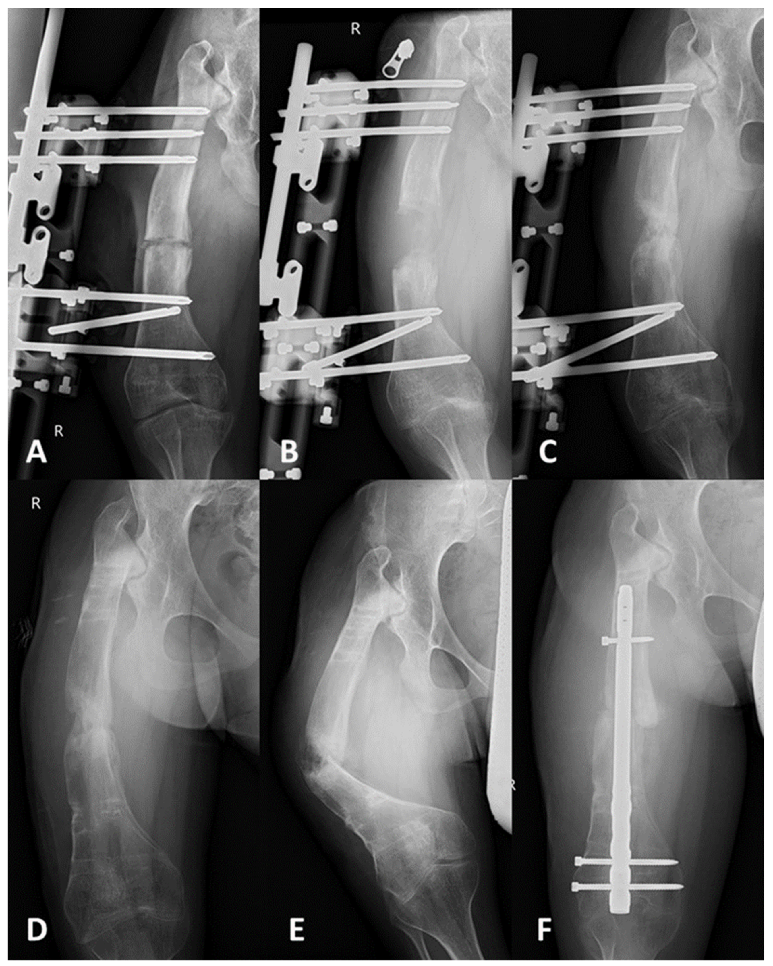 JCM | Free Full-Text | Comparison of Intramedullary Magnetic Nail,  Monolateral External Distractor, and Spatial External Fixator in Femur  Lengthening in Adolescents with Congenital Diseases | HTML
