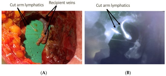 Preventing Lymphedema after Mastectomy - Oncovia