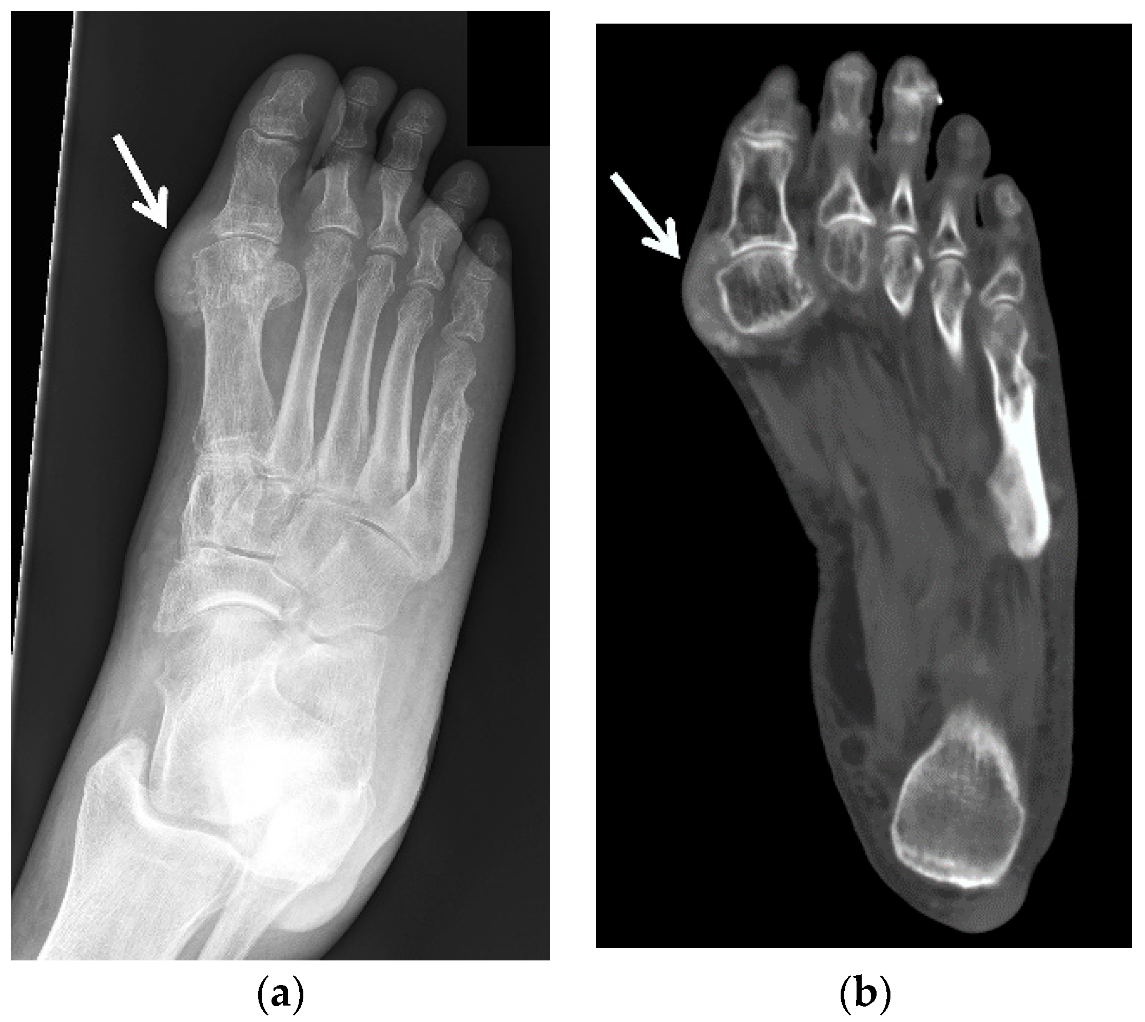 JCM | Free Full-Text | Gouty Arthropathy: Review of Clinical Manifestations  and Treatment, with Emphasis on Imaging | HTML