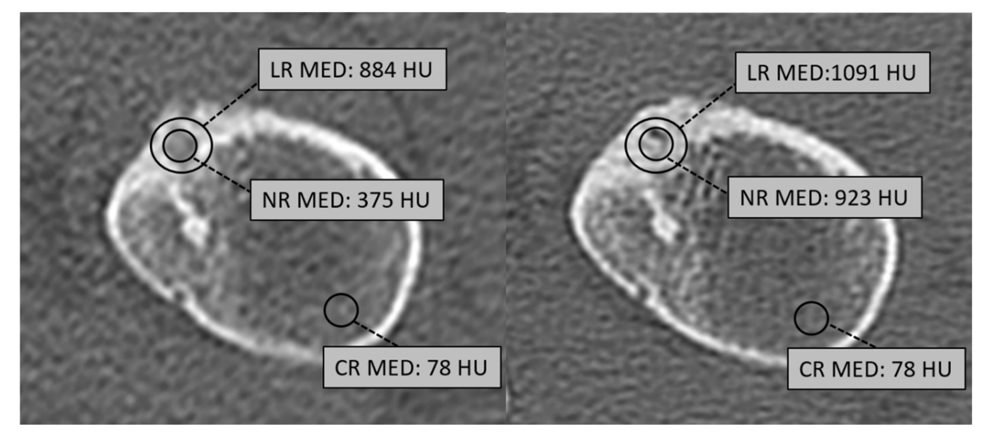 Jcm Free Full Text Weakening Or Structural Strengthening An Evaluation Of Bone Density 1547