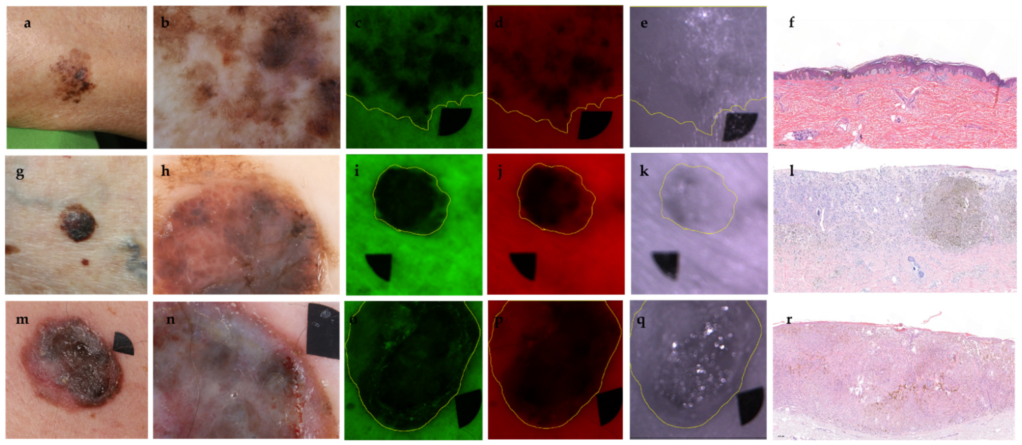 JCM | Free Full-Text | Multispectral Imaging Algorithm Predicts Breslow  Thickness of Melanoma